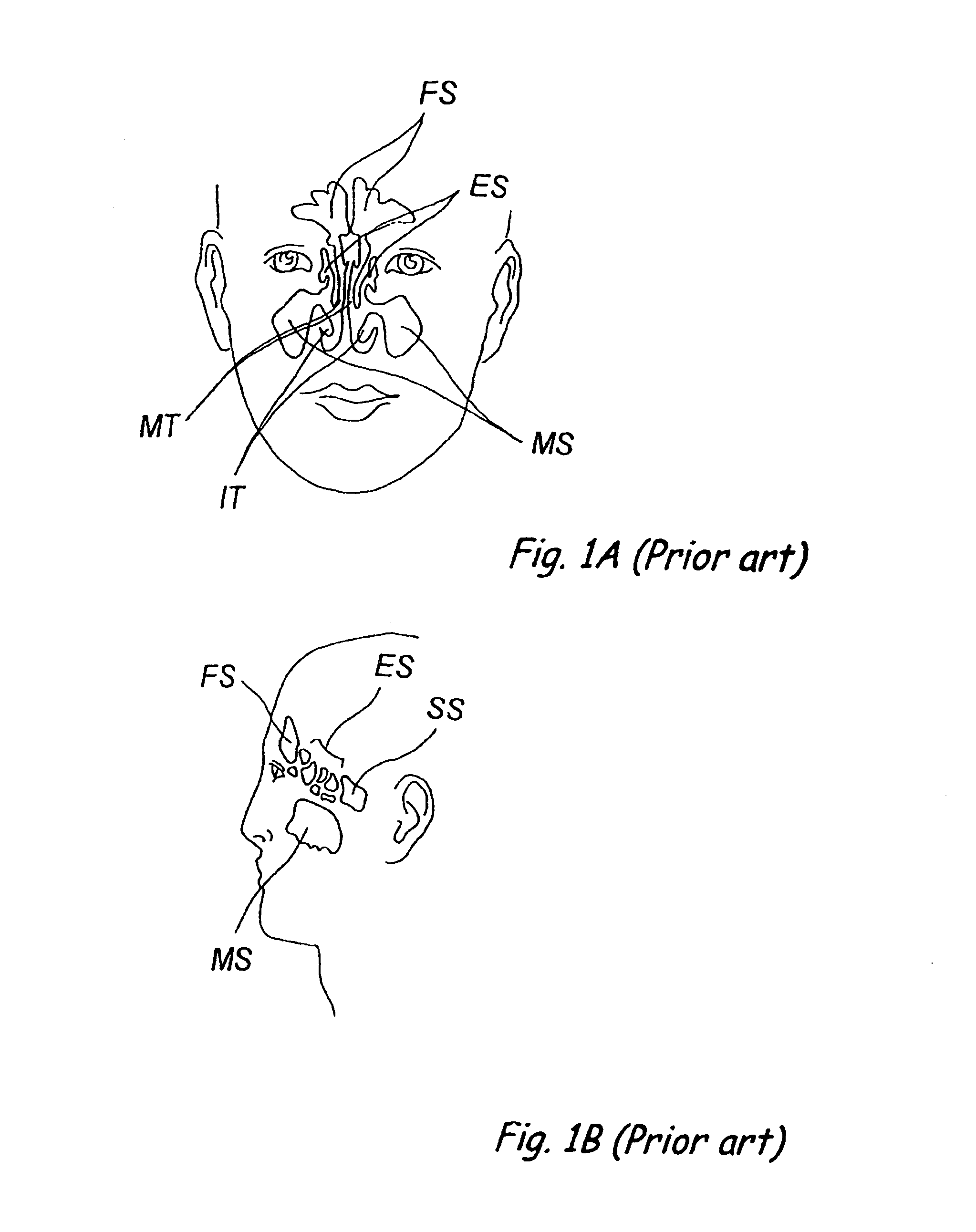 Devices, systems and methods for diagnosing and treating sinusitis and other disorders of the ears, Nose and/or throat