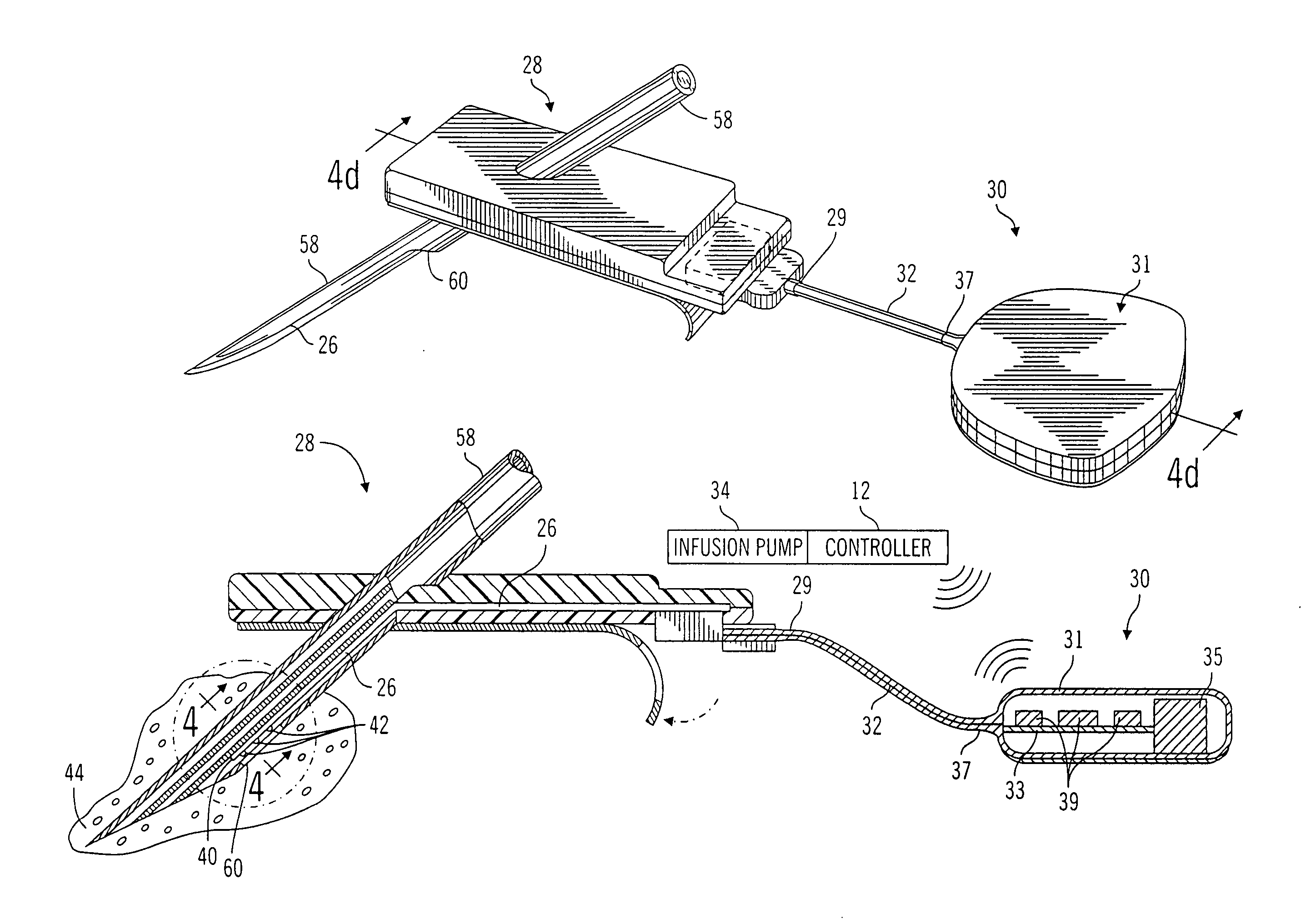 Closed loop system for controlling insulin infusion