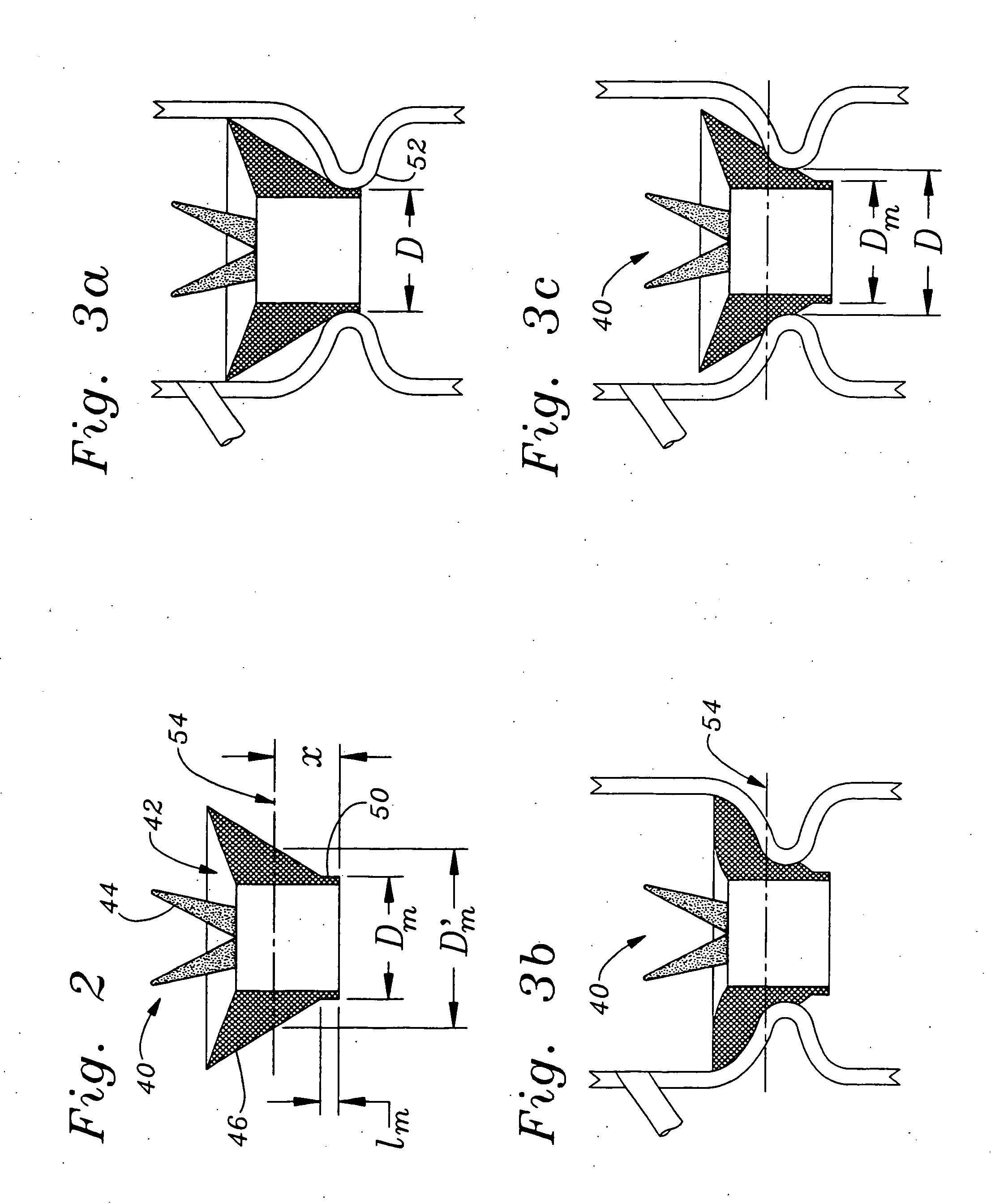 Heart valve sizers dimensioned larger than corresponding heart valves