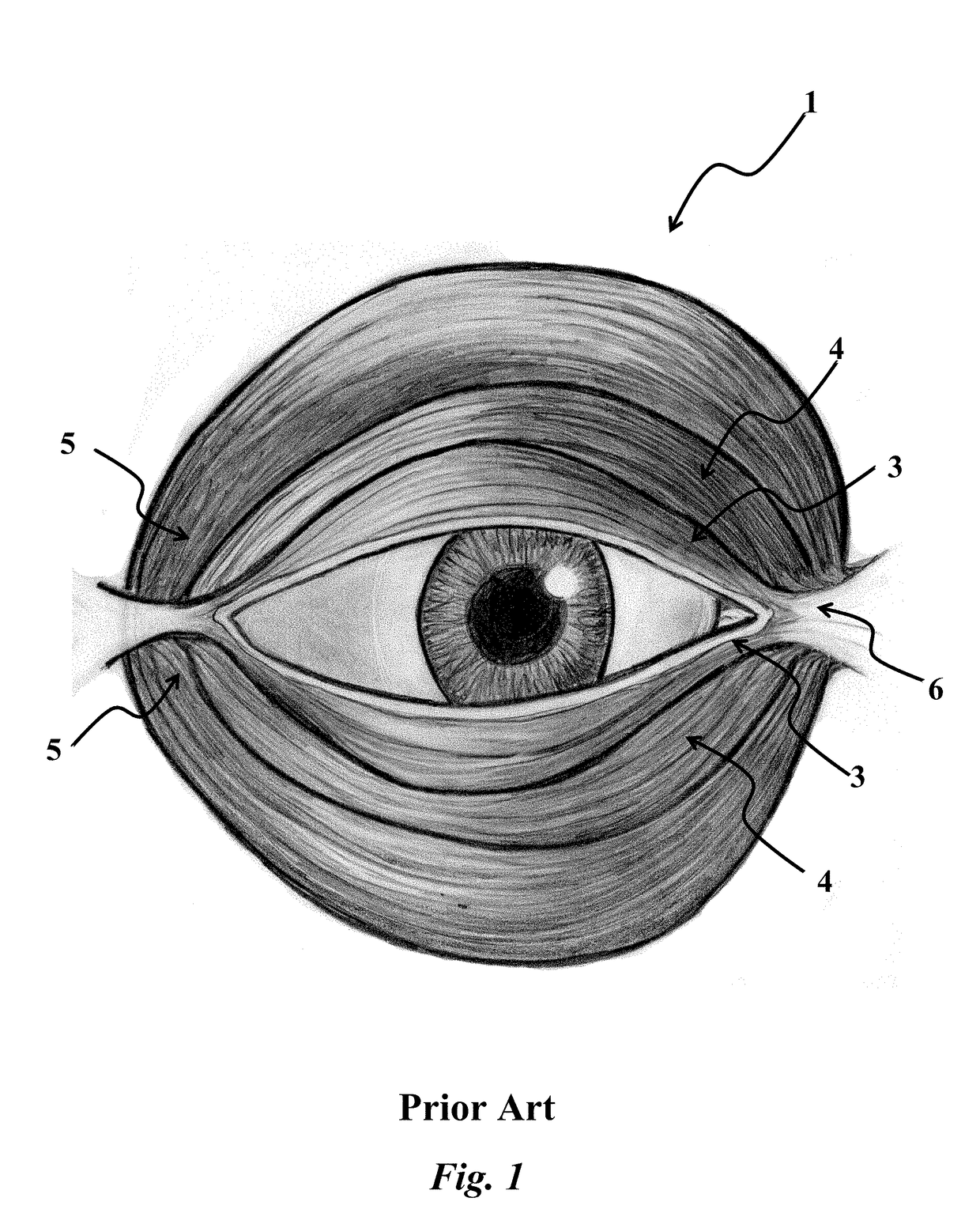 Medial orbicularis flap canthoplasty with obicularisorrhaphy