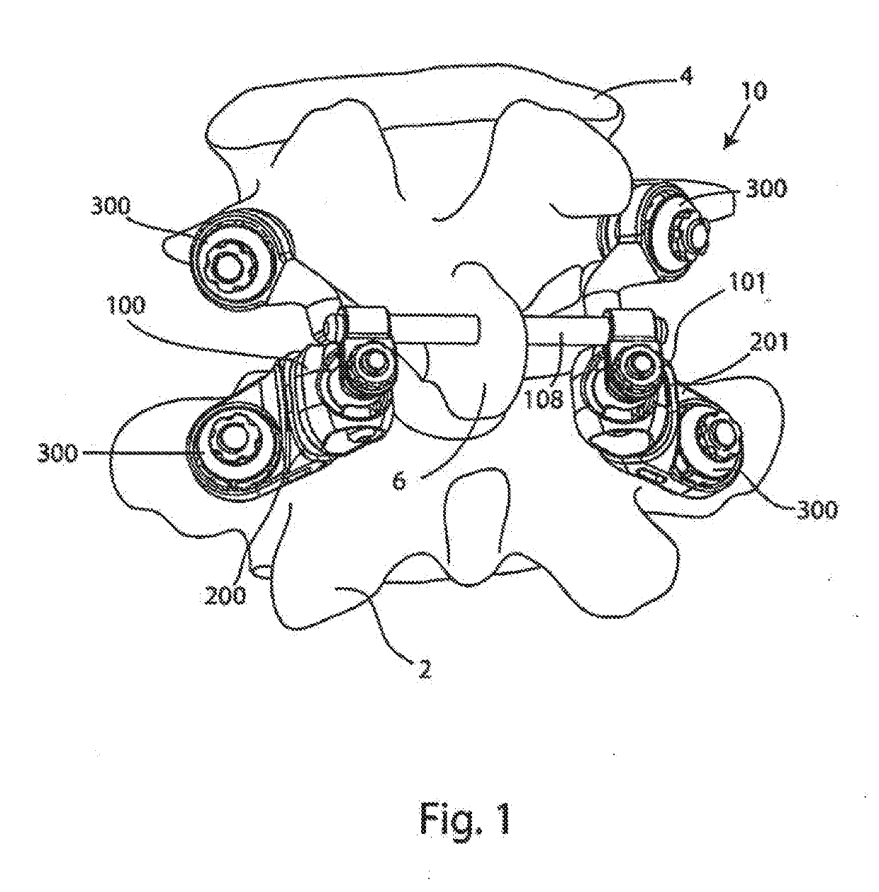 System and method for facet joint replacement