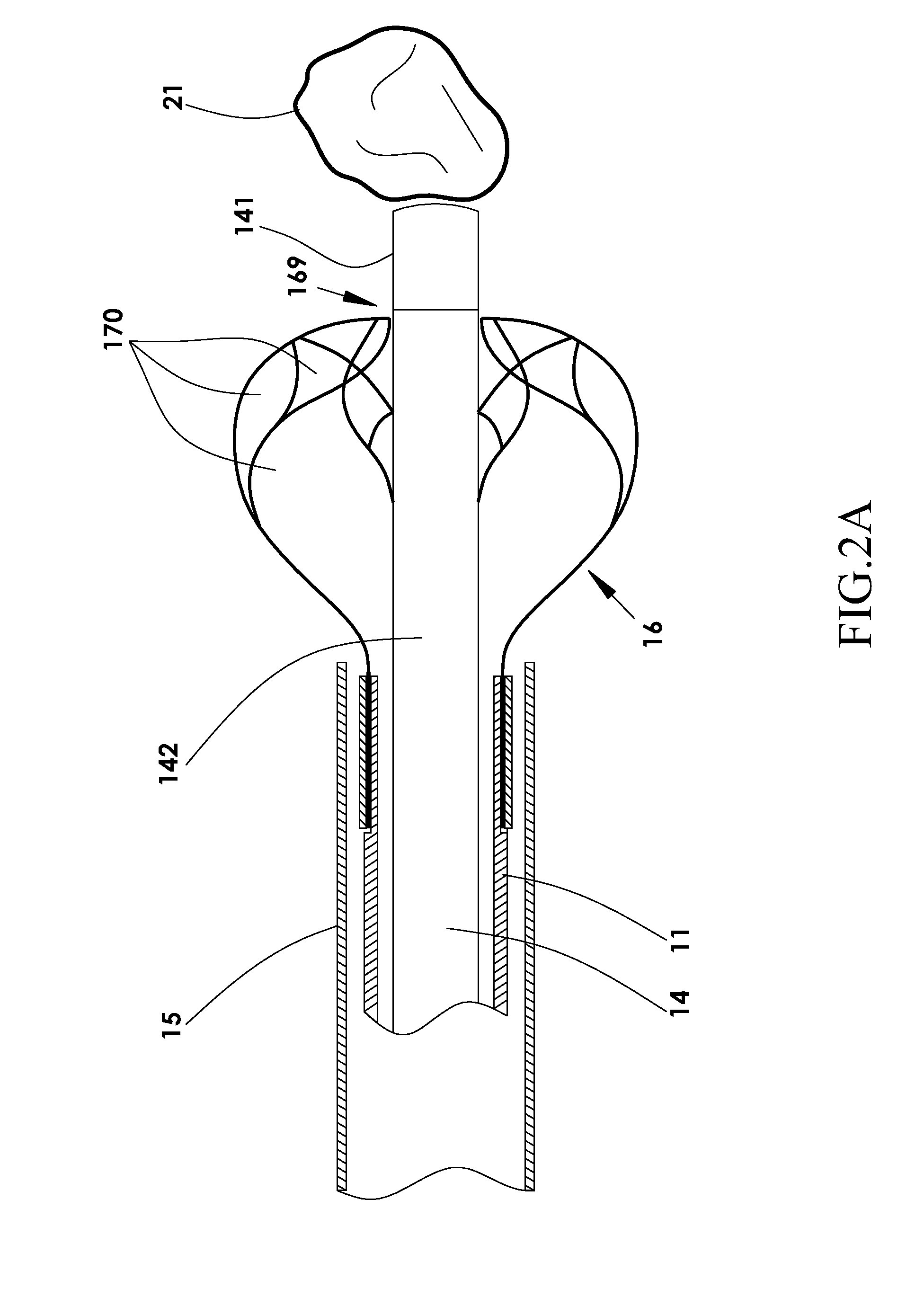 Device and method for fragmenting and removing concretions from body ducts and cavities