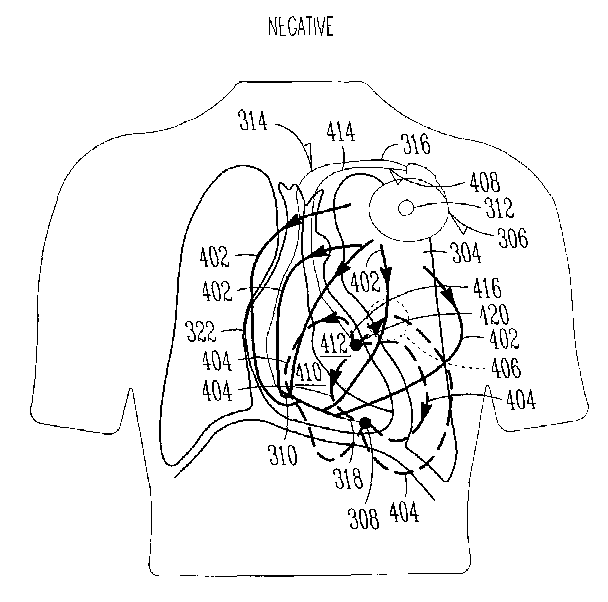 Monitoring fluid in a subject using an electrode configuration providing negative sensitivity regions