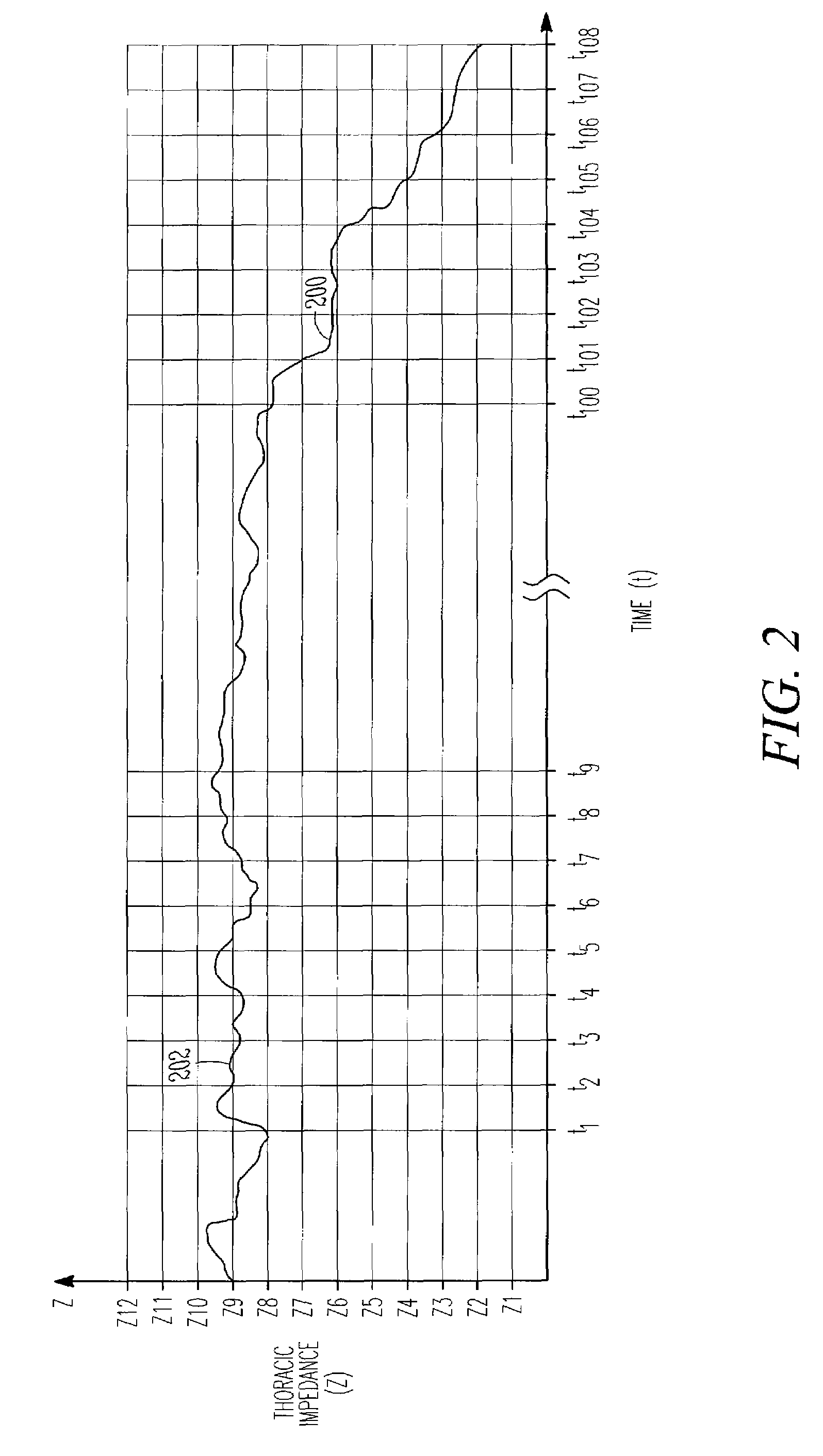 Monitoring fluid in a subject using an electrode configuration providing negative sensitivity regions