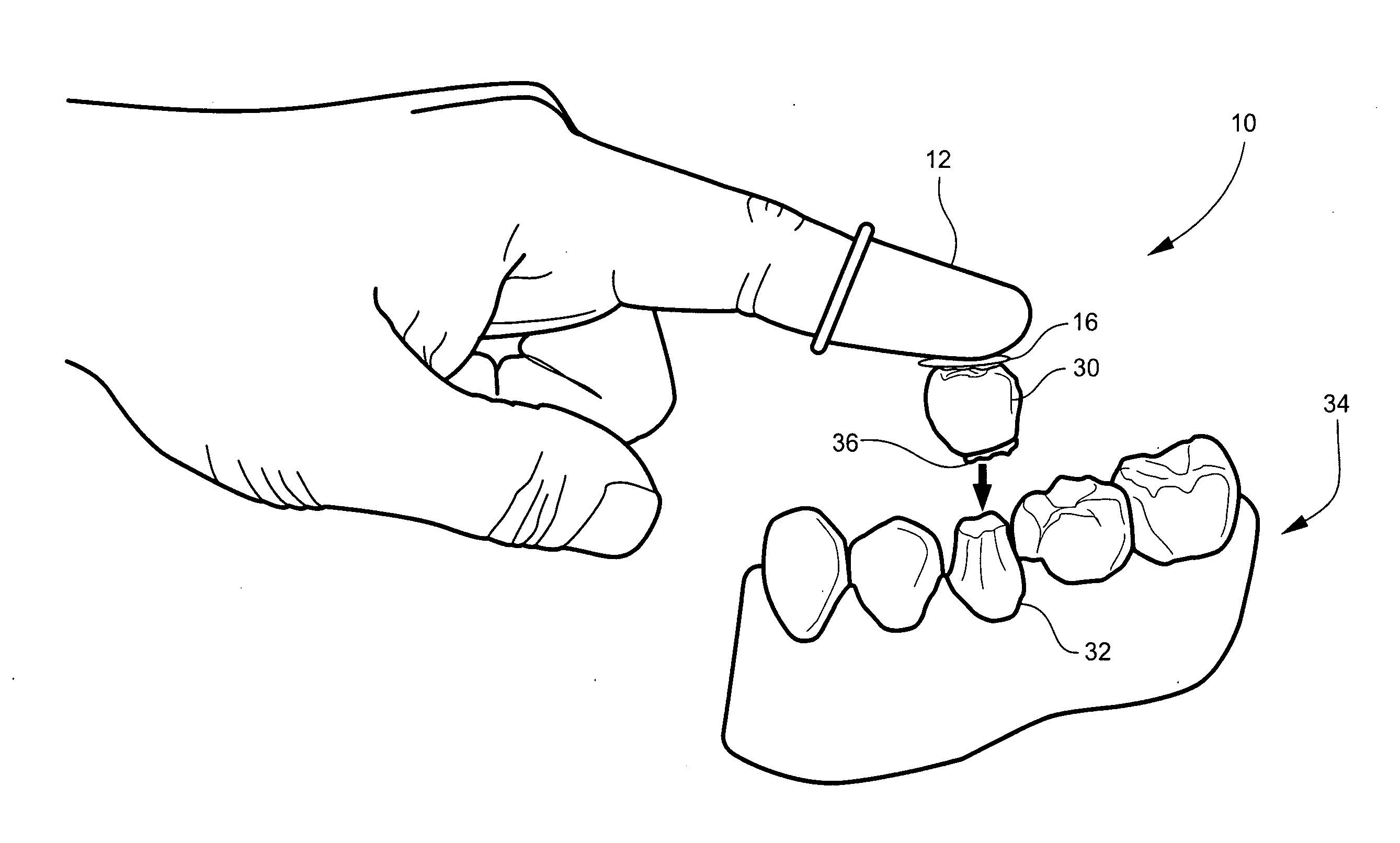 Prosthodontic tool and method for placing and fitting crowns and inlays