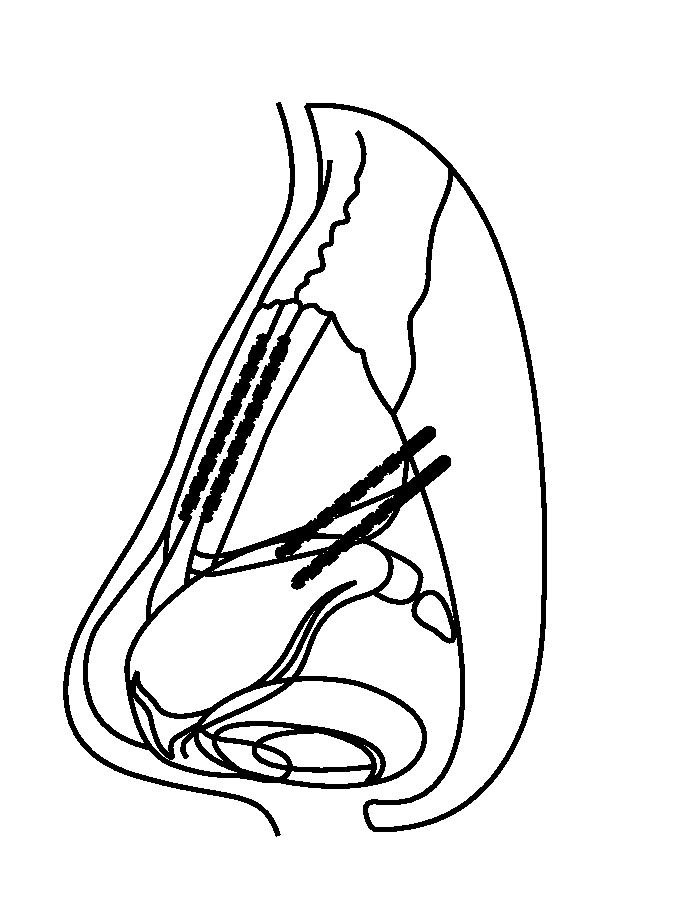 Nasal implants and systems and methods of use