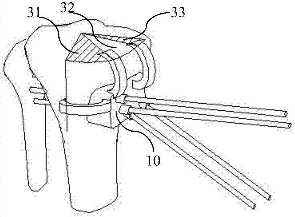 Auxiliary tool for inner side high tibial osteotomy