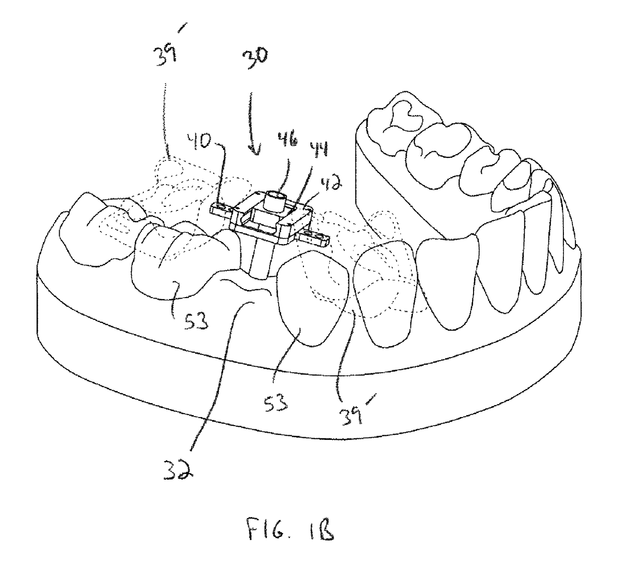 Surgical guide for dental implant and methods therefor