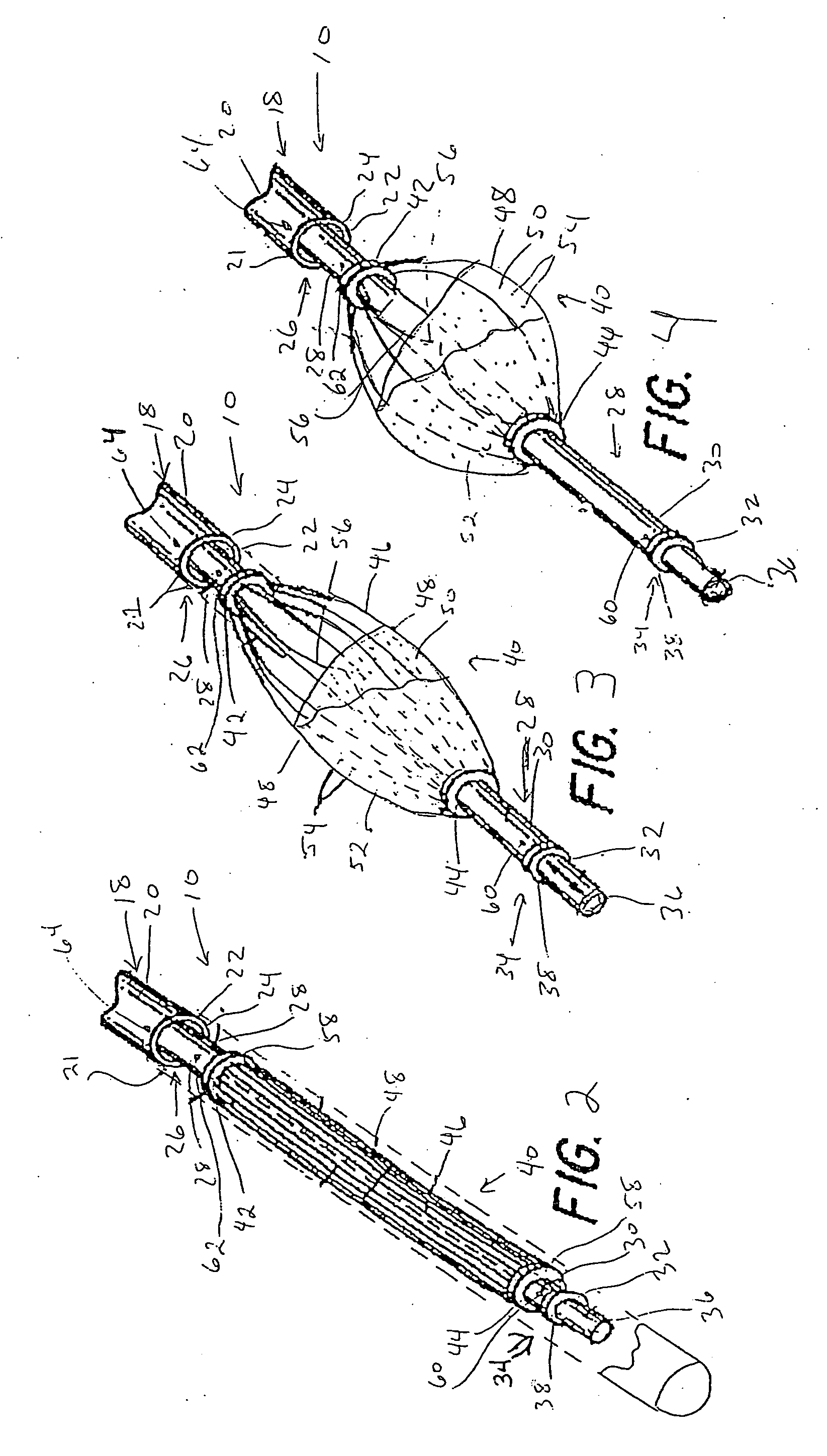 Methods for trapping emboli