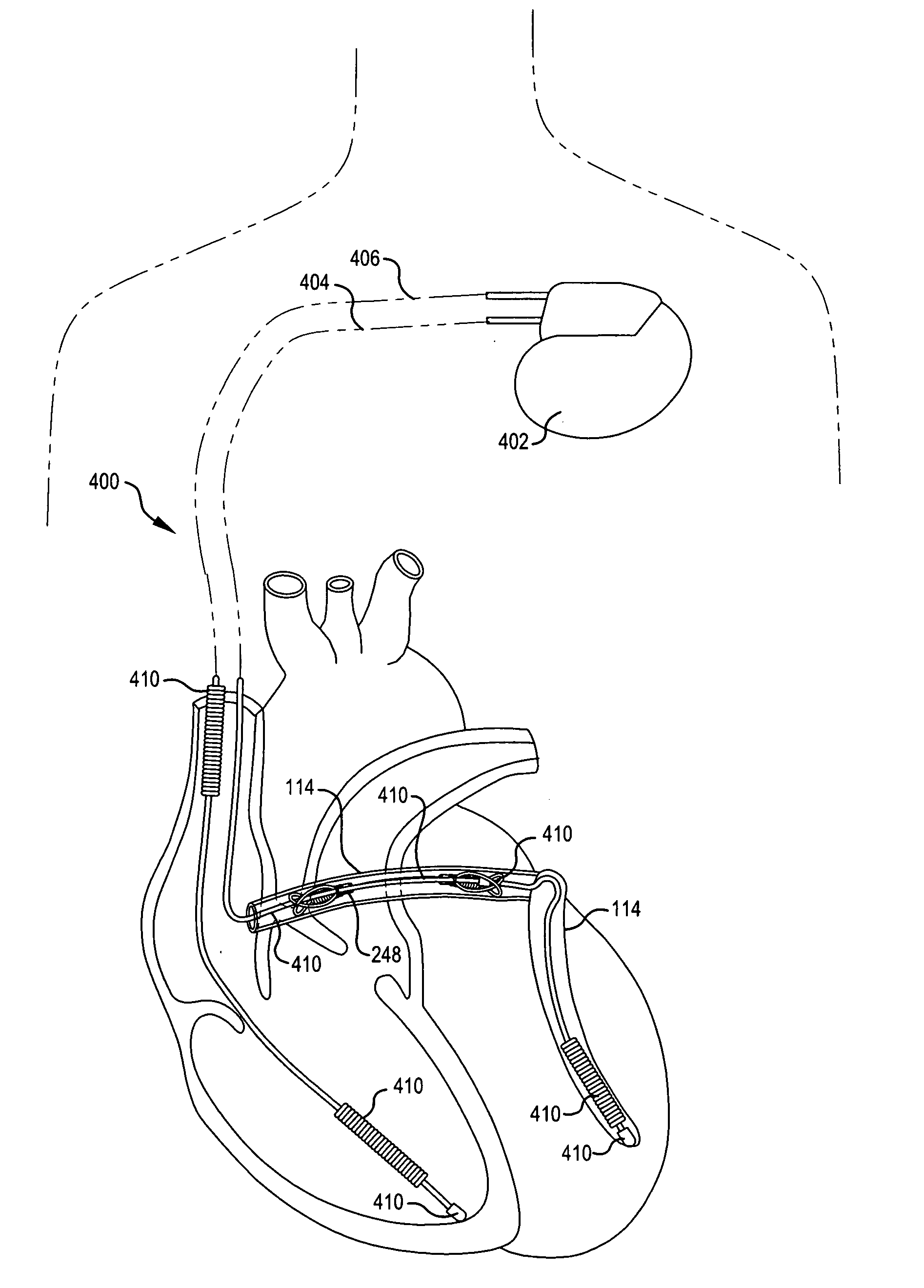 Body lumen shaping device with cardiac leads