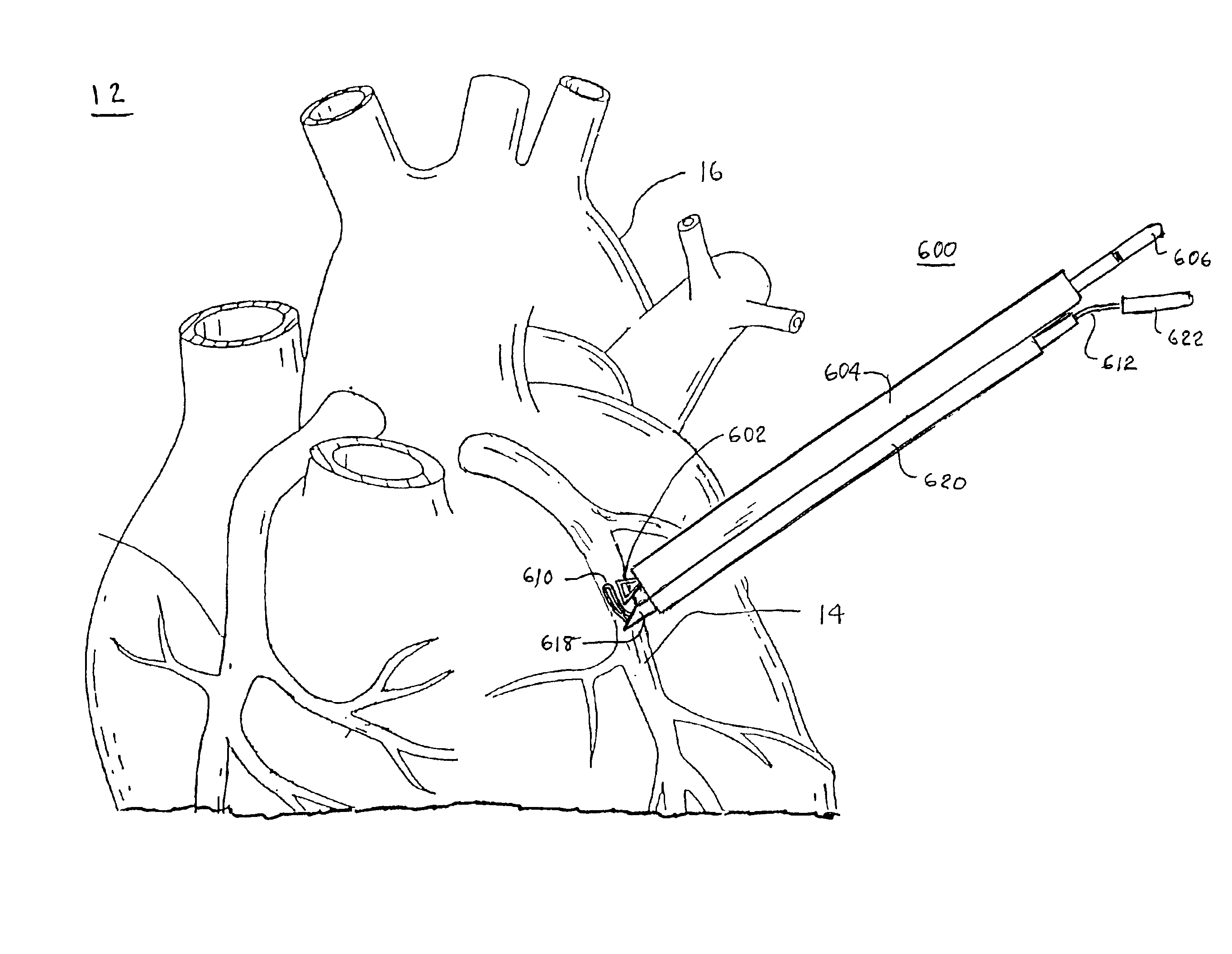 Electrosurgical methods and apparatus for making precise incisions in body vessels