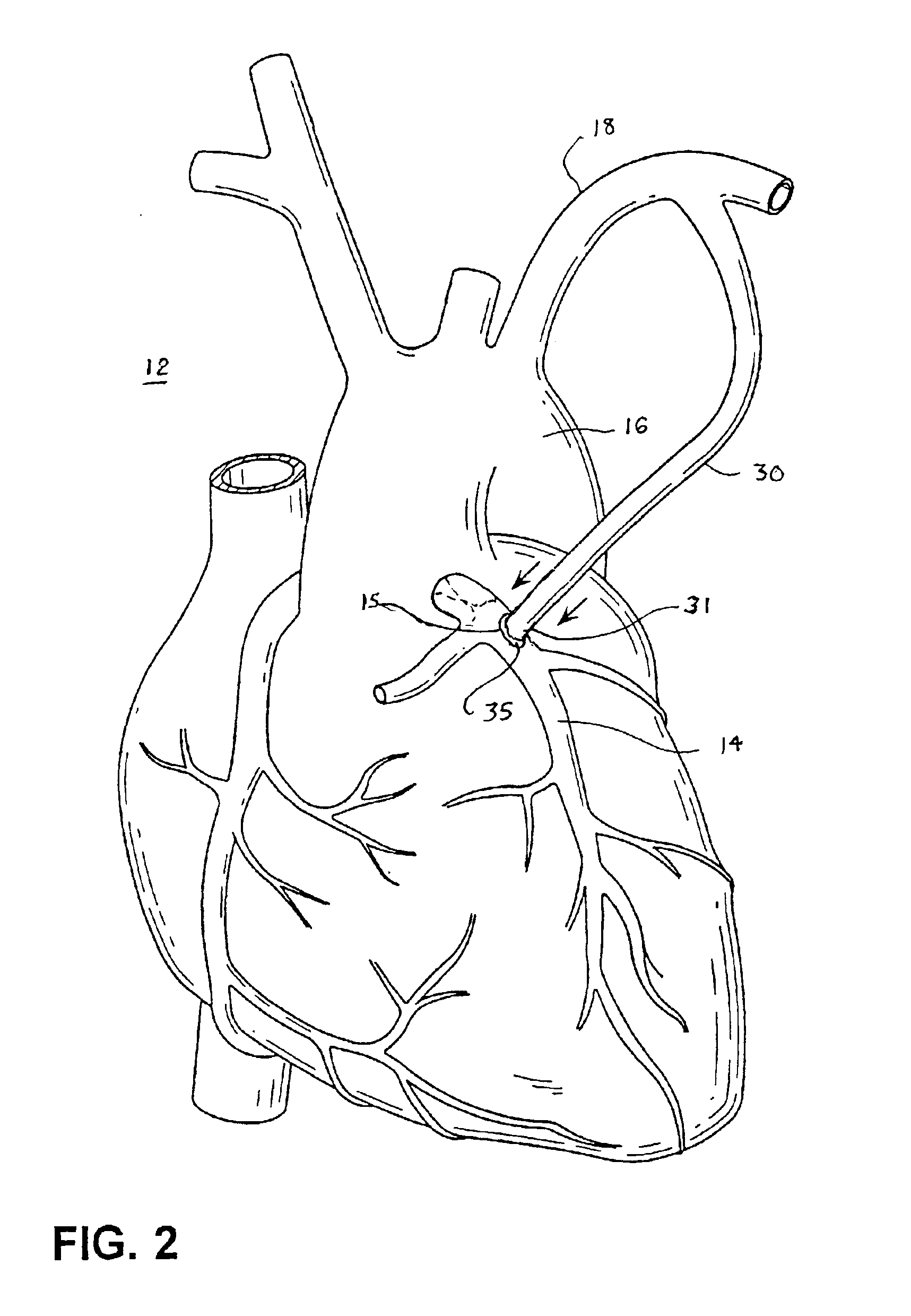 Electrosurgical methods and apparatus for making precise incisions in body vessels