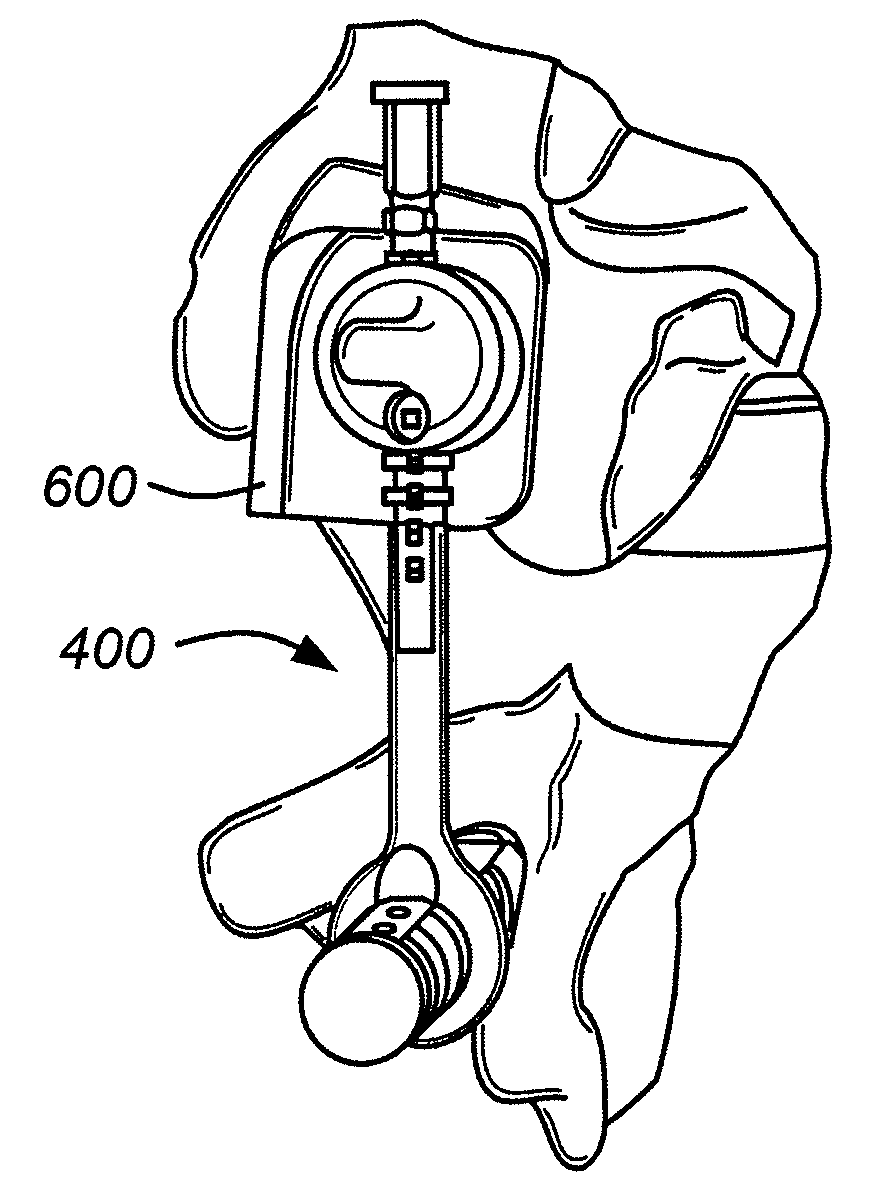 Implantable orthopedic device component selection instrument and methods