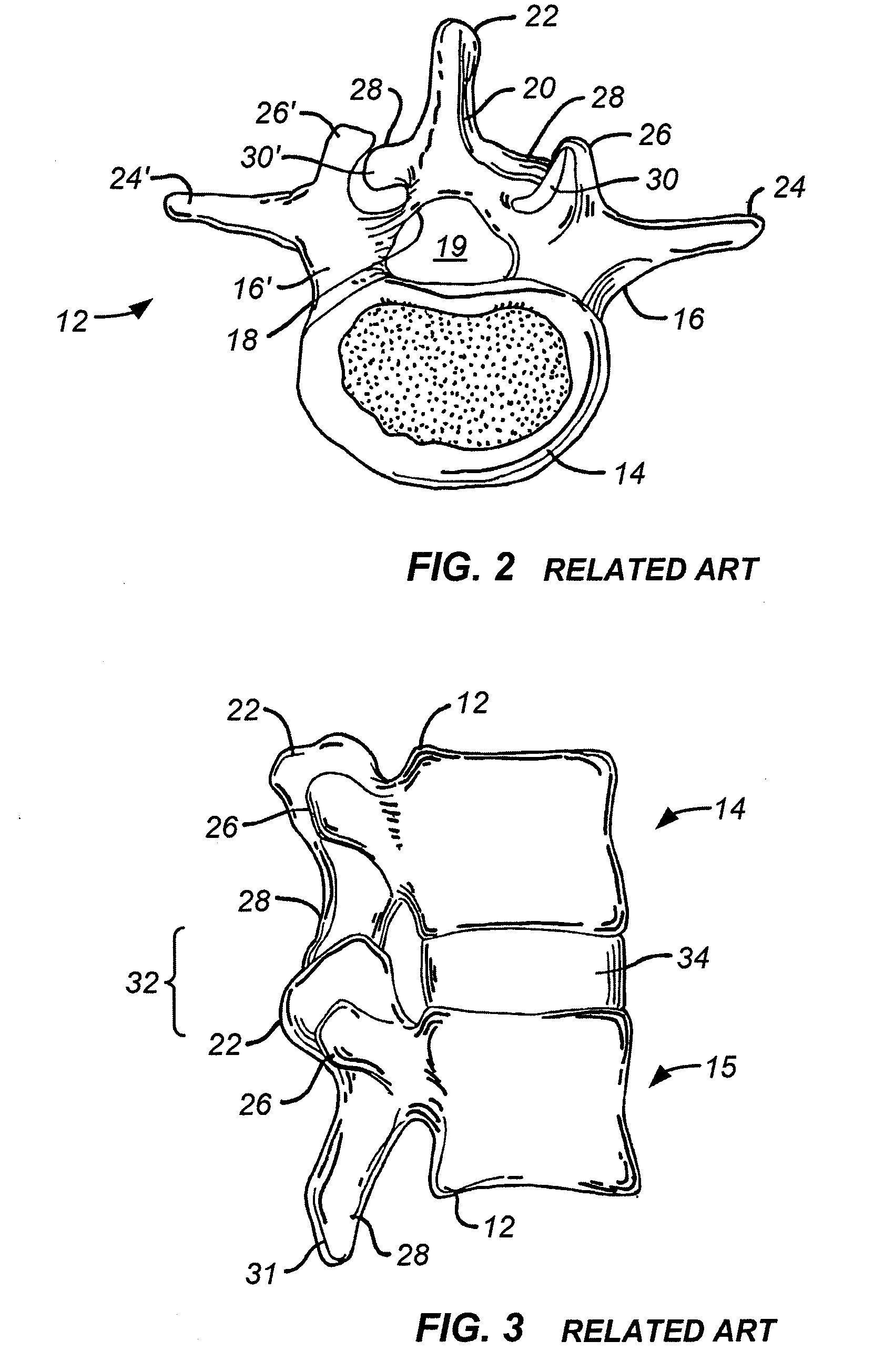 Implantable orthopedic device component selection instrument and methods