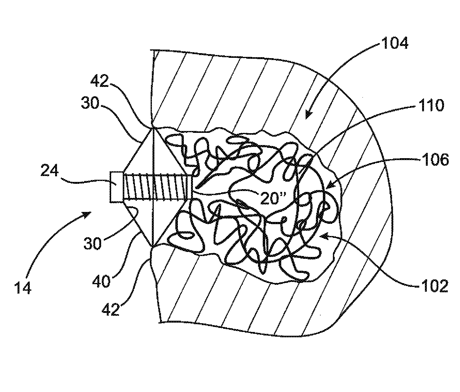 Assembly and method for left atrial appendage occlusion