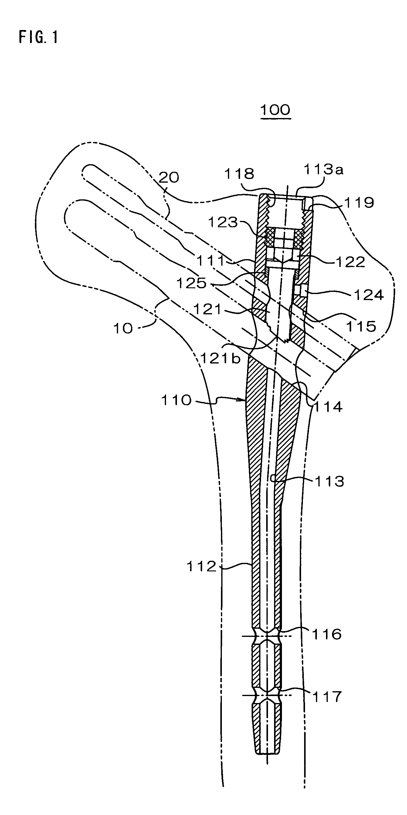 Intramedullary nail