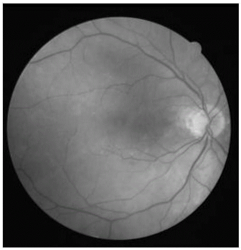 Automatic eyeground image blood vessel segmentation method based on Gabor filters