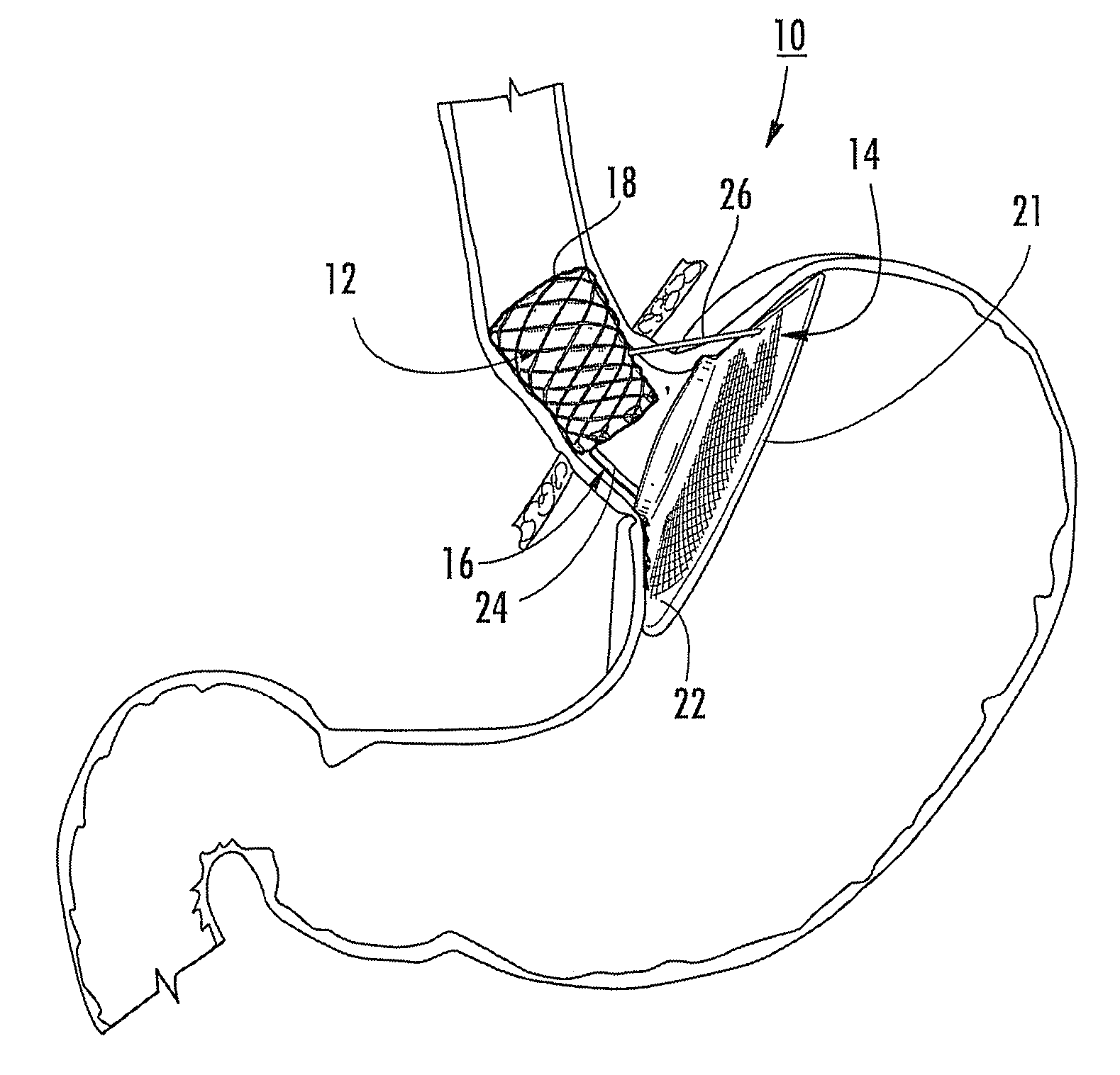 Bariatric device and method