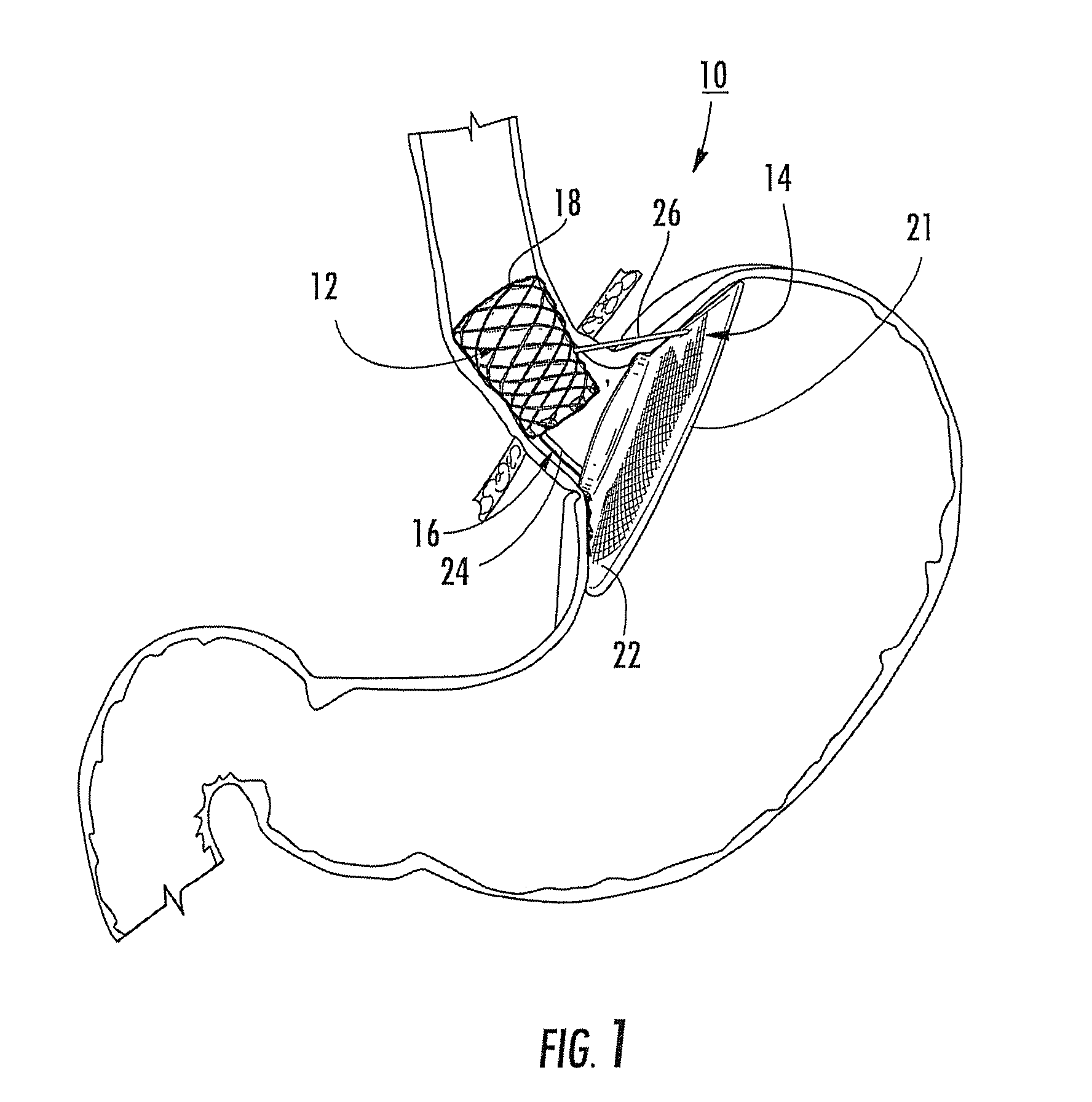 Bariatric device and method