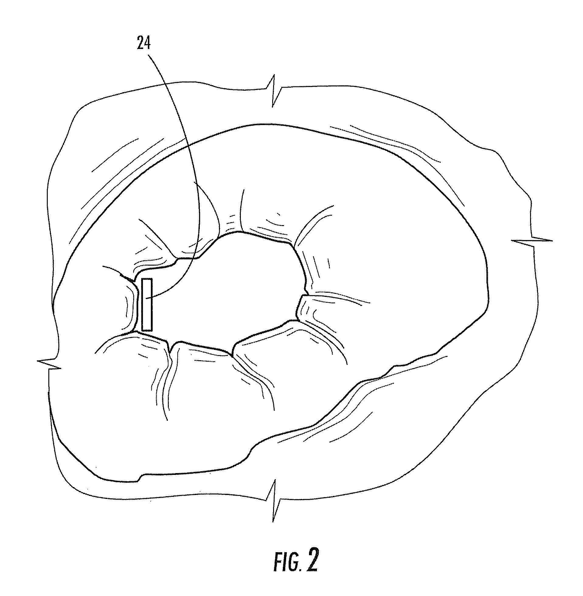 Bariatric device and method