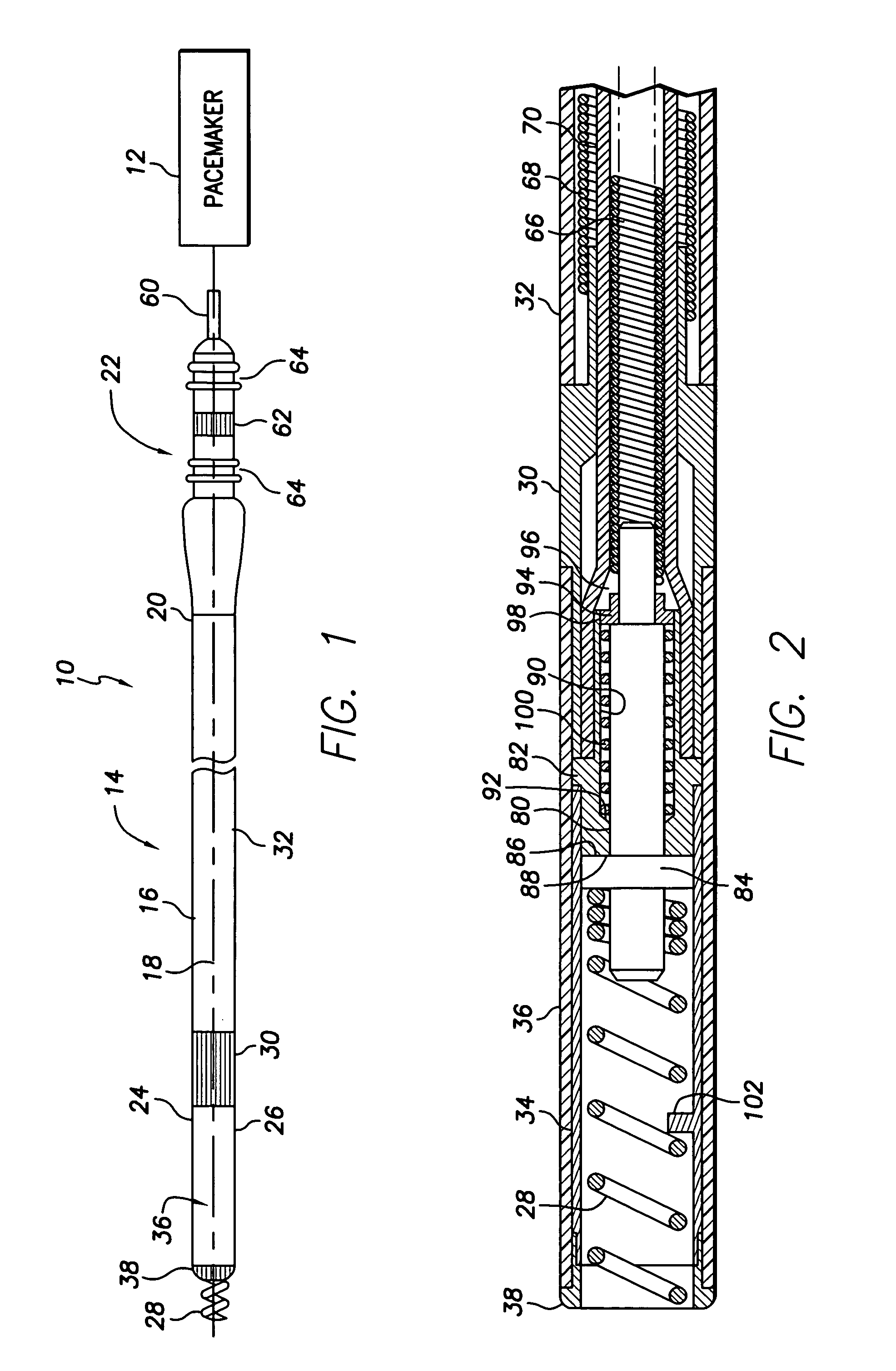 Active fixation lead with multiple density