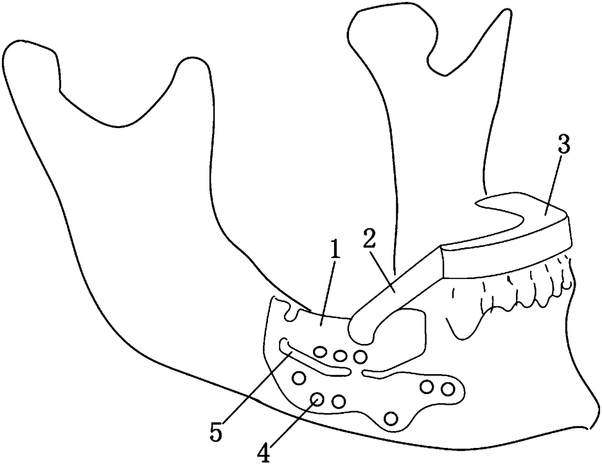 Tooth-support-type guide plate device of alveolar crest retractor and production method of tooth-support-type guide plate device