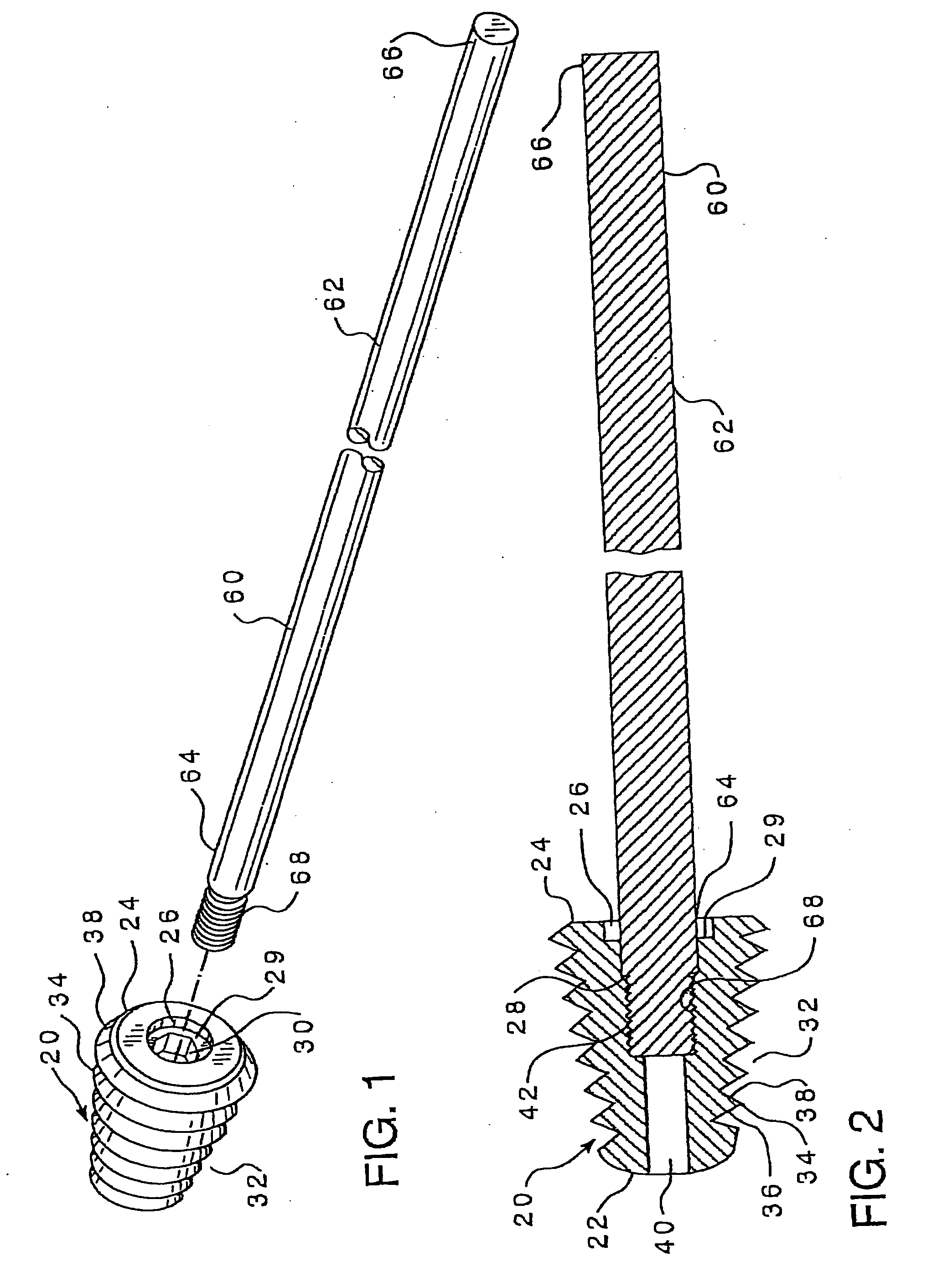 Subtalar implant and methods of use thereof