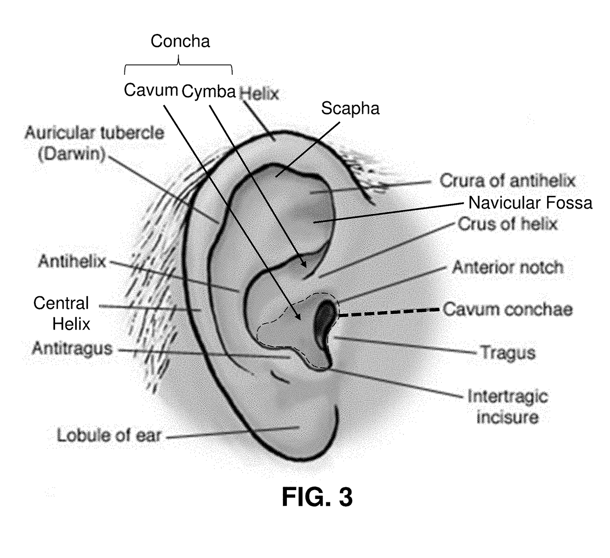 Transcutaneous electrostimulator and methods for electric stimulation