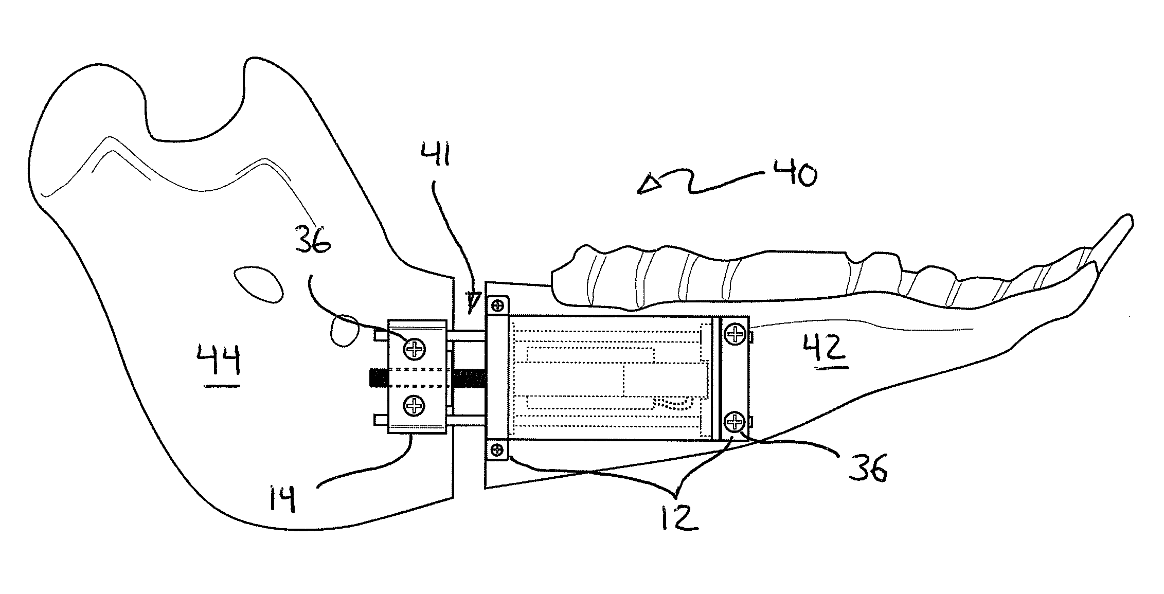 Implantable distraction osteogenesis device and methods of using same