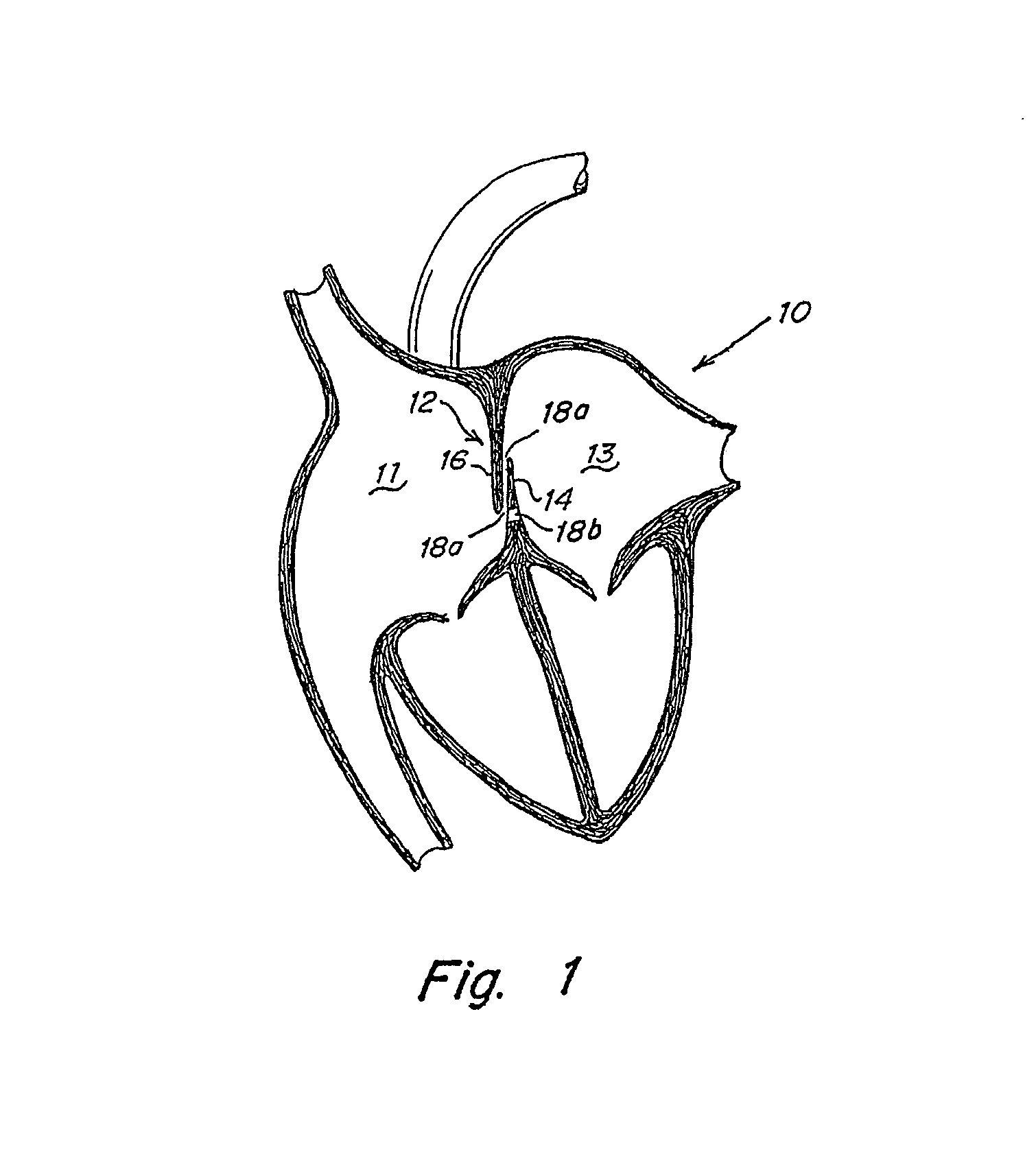 Deformable flap catch mechanism for occluder device