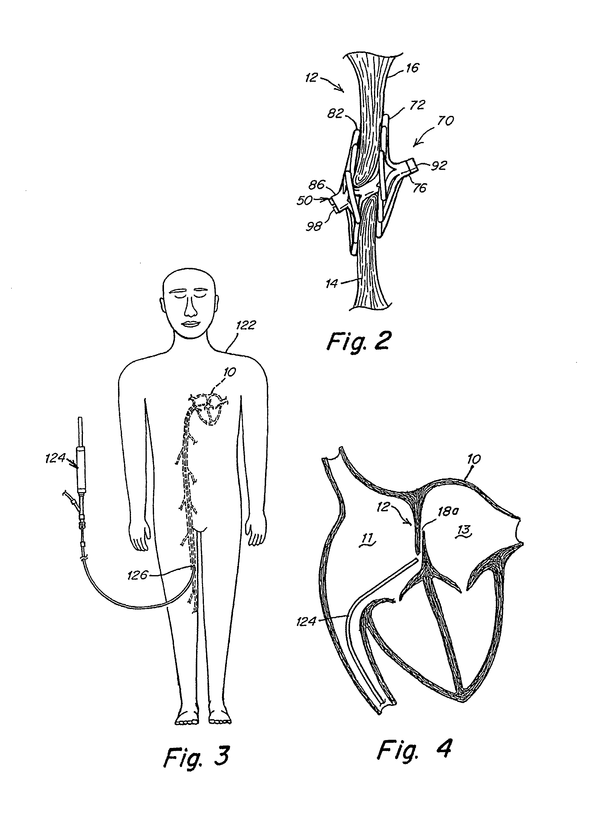 Deformable flap catch mechanism for occluder device