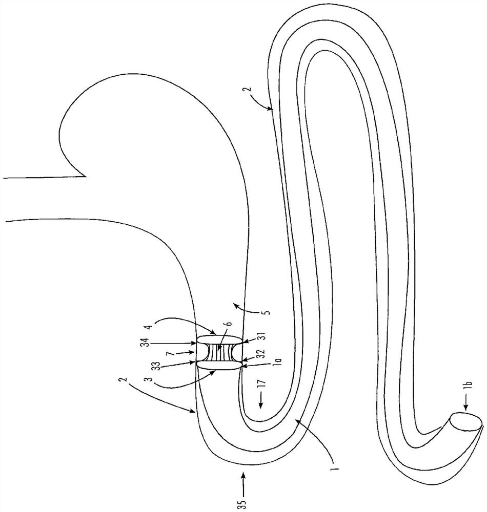 Gastrointestinal implant and positioning device for same