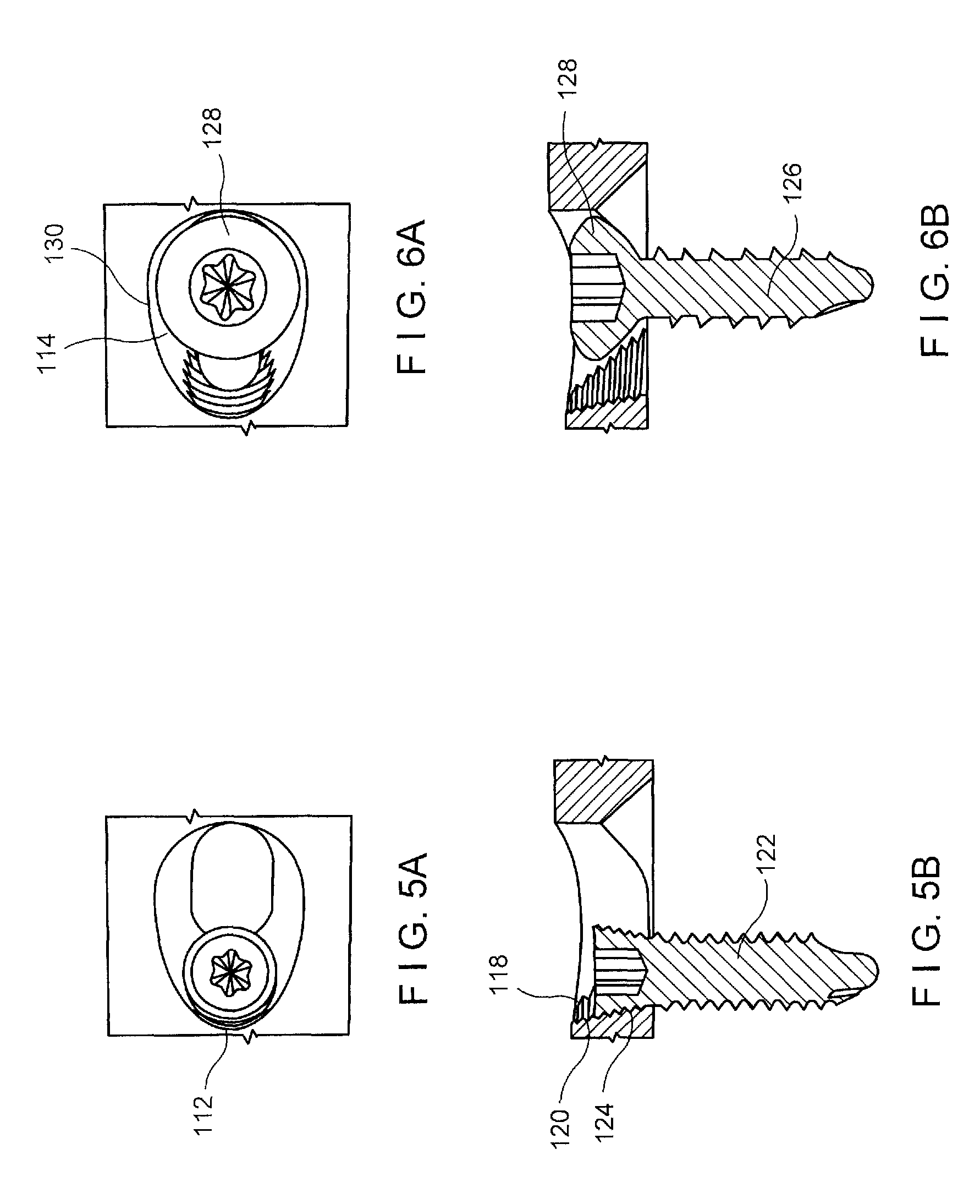 Ulna osteotomy system