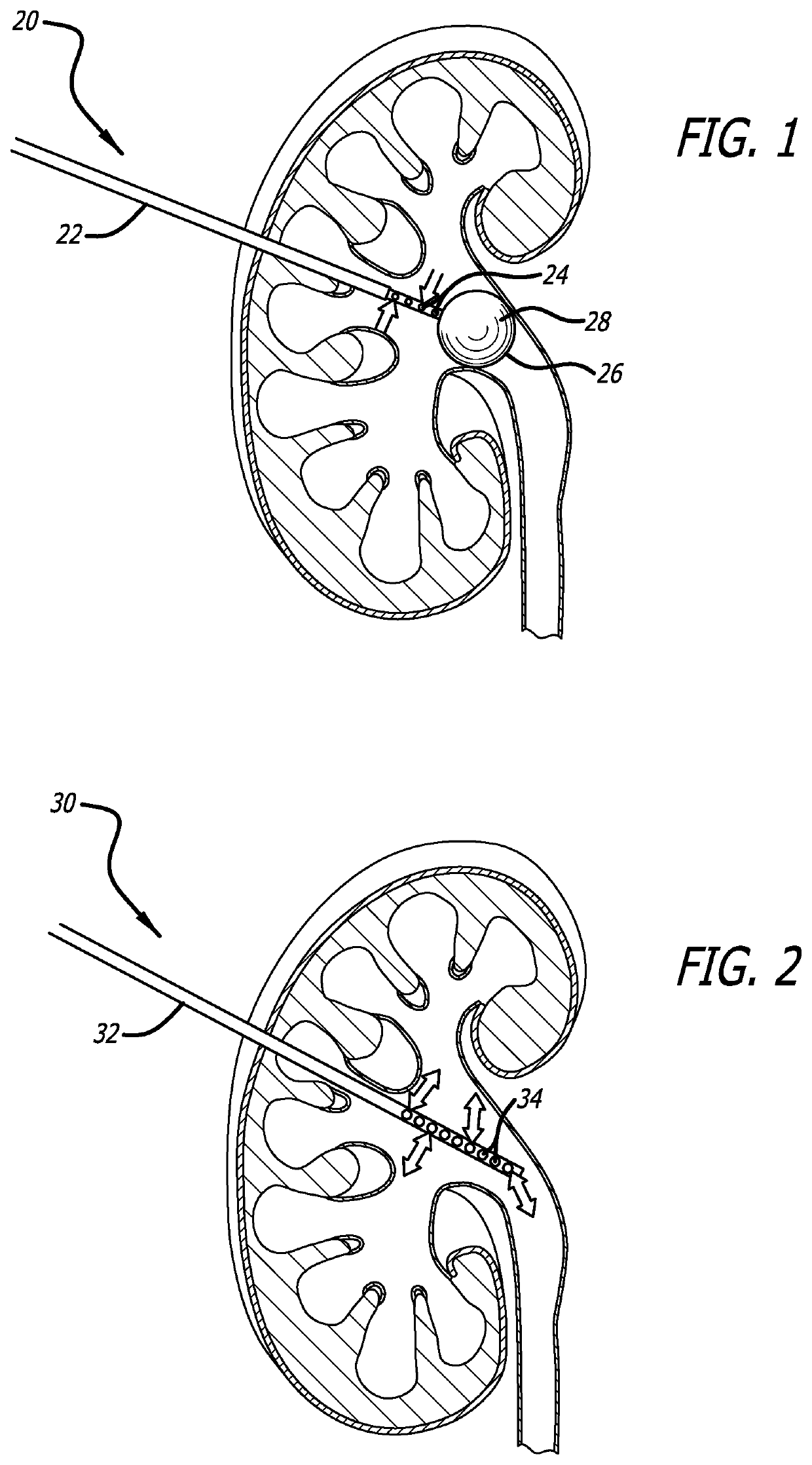 Urine Collecting System Interventions For Improving Kidney Function