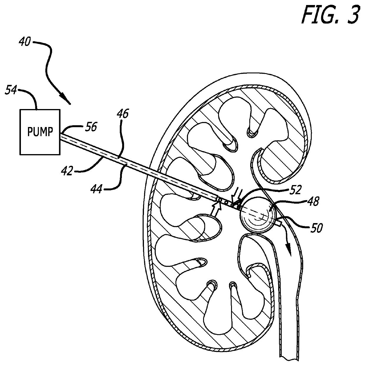 Urine Collecting System Interventions For Improving Kidney Function