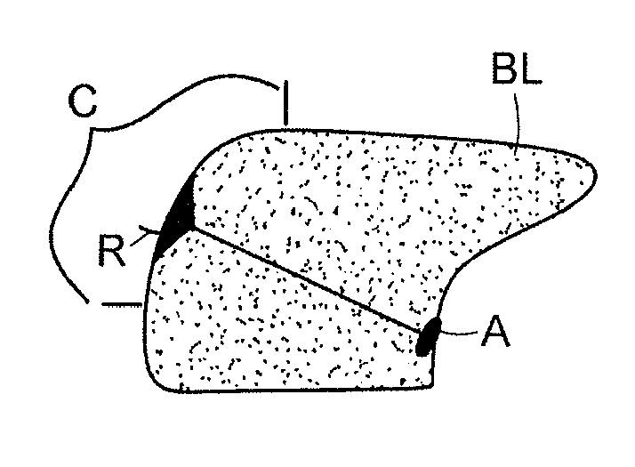 Methods and Devices for Treating Sleep Apnea and Snoring