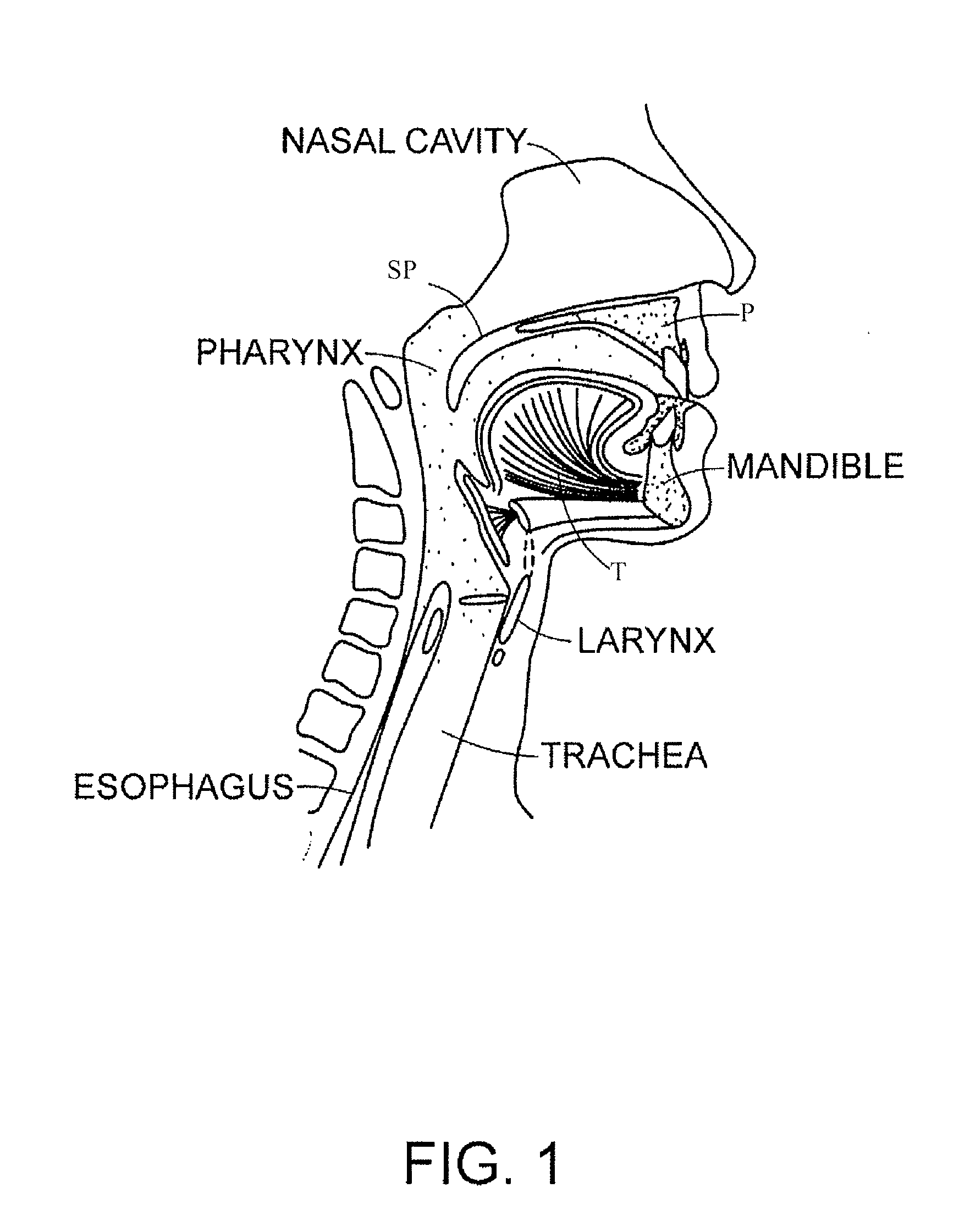 Methods and Devices for Treating Sleep Apnea and Snoring