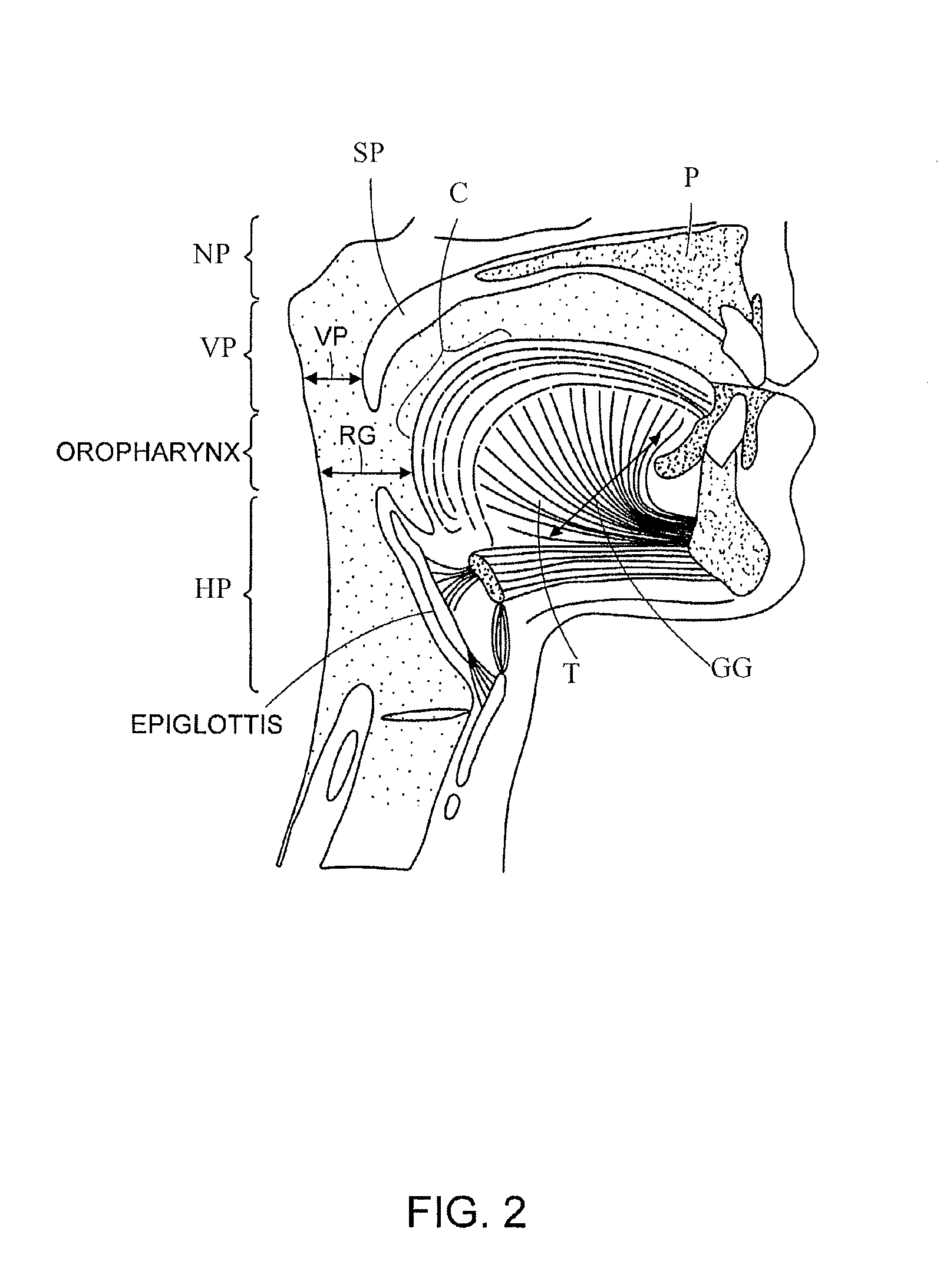 Methods and Devices for Treating Sleep Apnea and Snoring