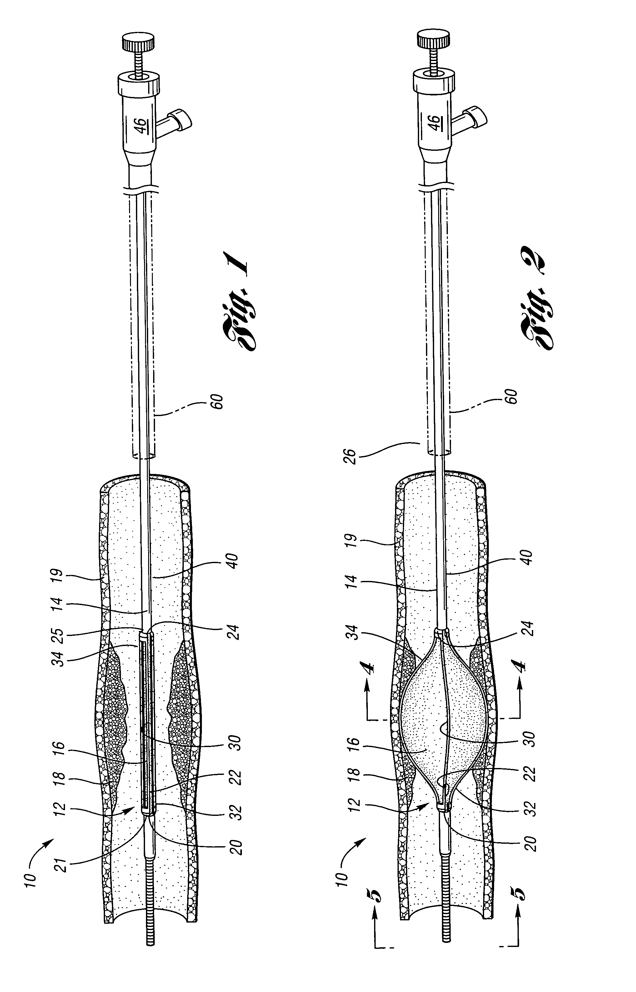 Angioplasty cutting device and method for treating a stenotic lesion in a body vessel