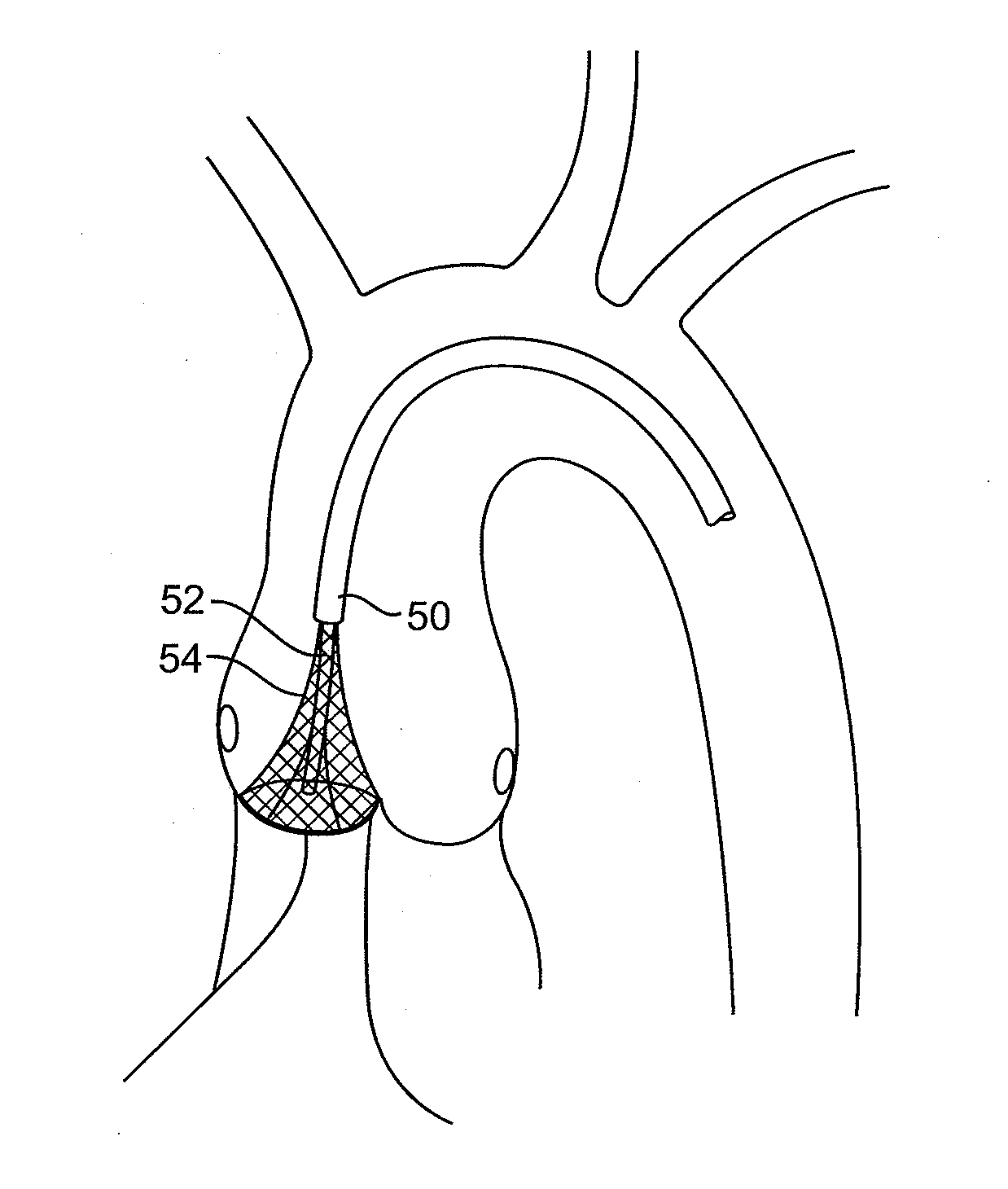 Aortic Valve Repair