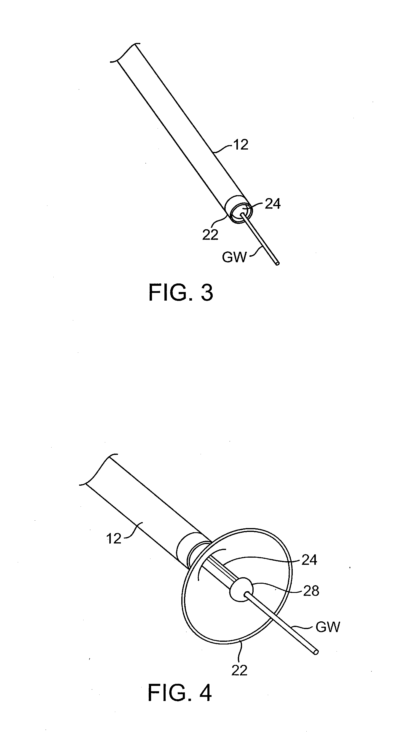 Aortic Valve Repair