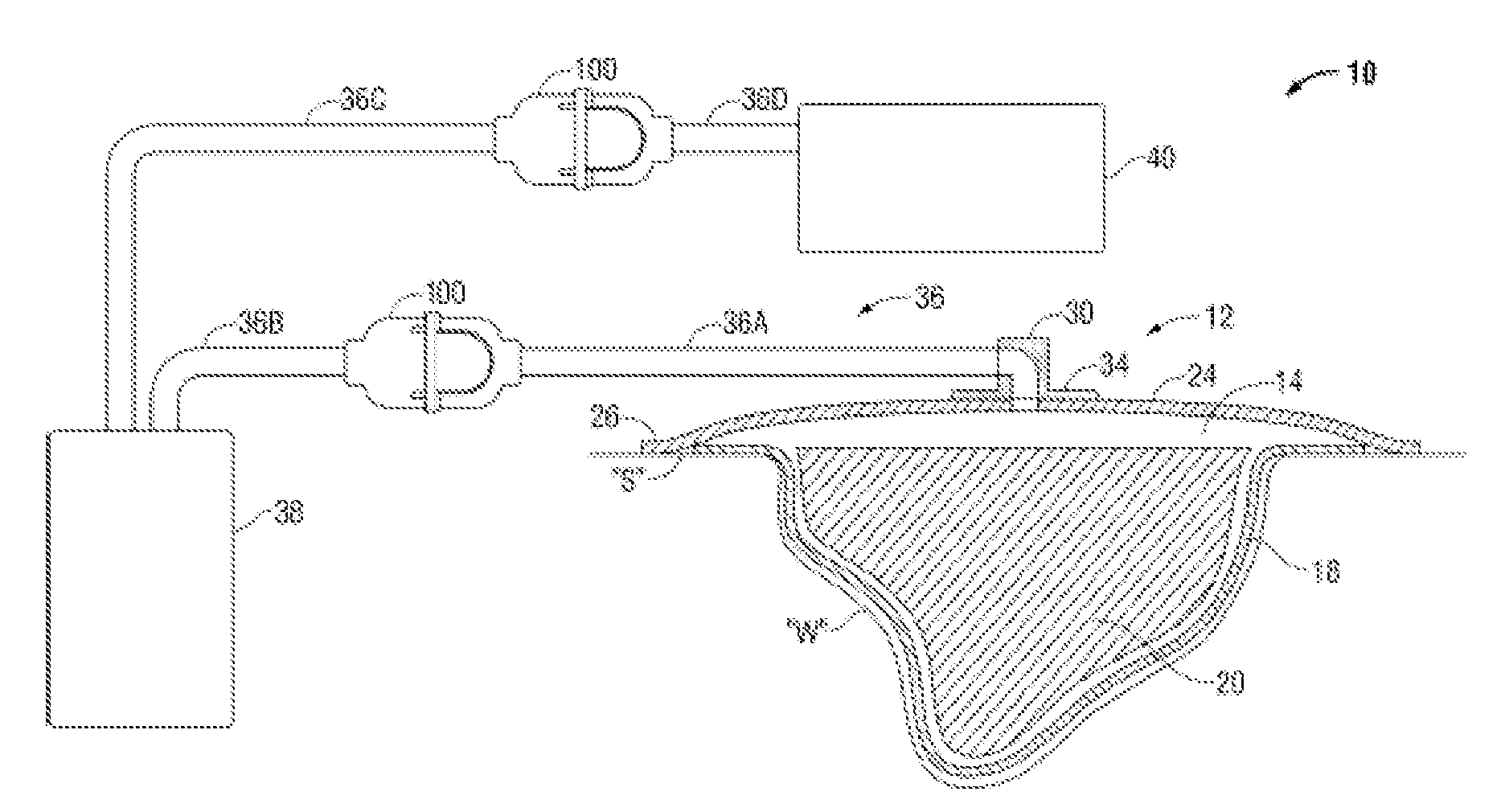 Portable Negative Pressure Wound Therapy Device