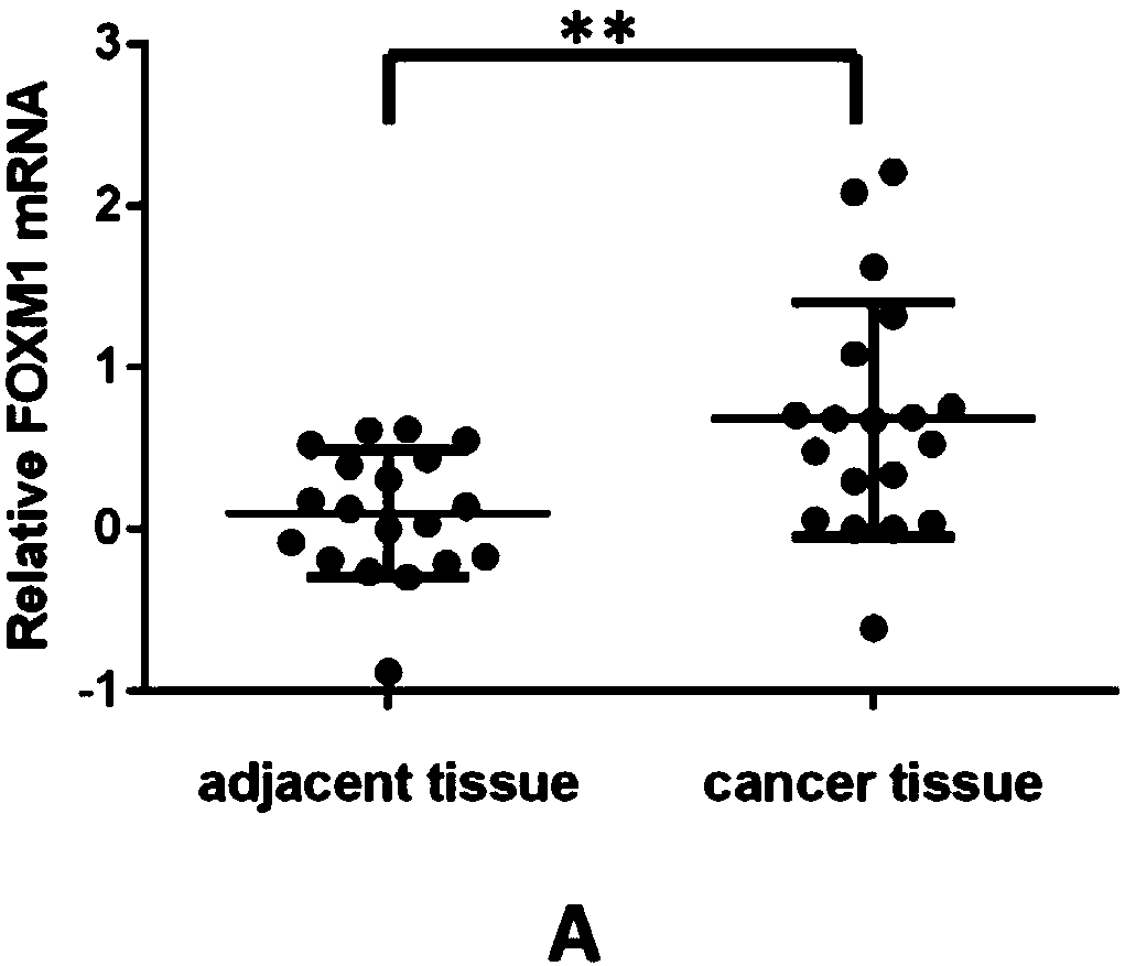 Application of FOXM1 inhibitor to treatment of intrahepatic cholangiocarcinoma