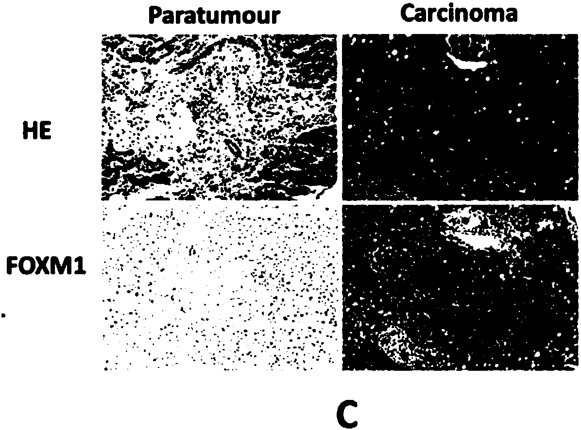 Application of FOXM1 inhibitor to treatment of intrahepatic cholangiocarcinoma