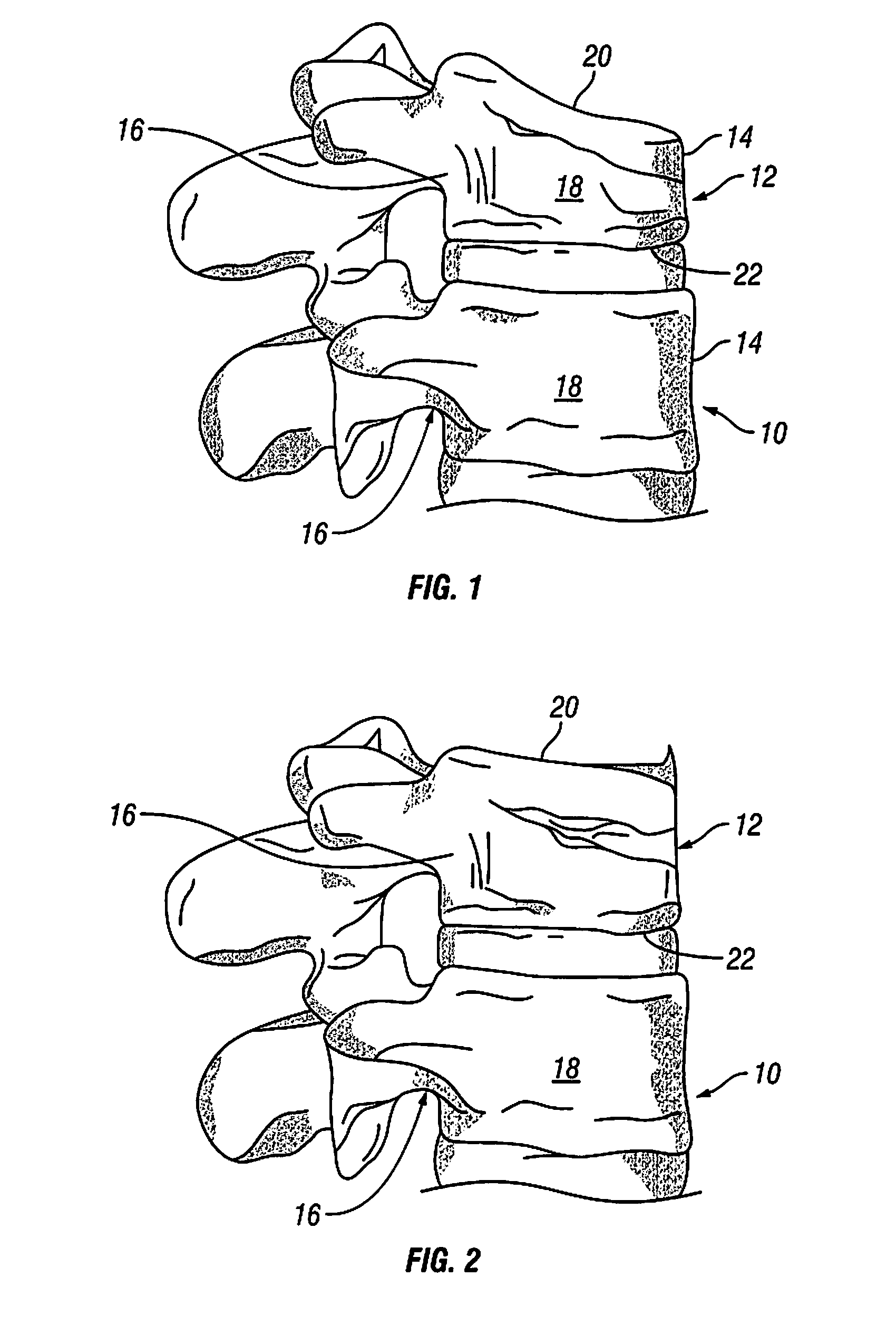 Devices and methods for treating bone