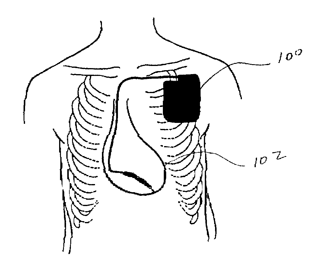 Method of and apparatus for tachycardia detection and treatment