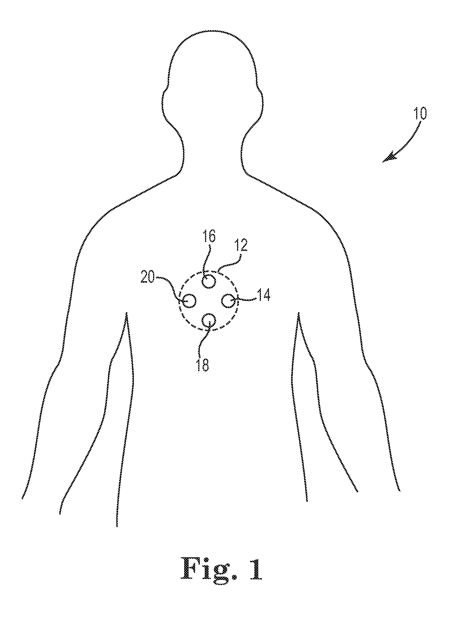 Minimally invasive aortic valve replacement