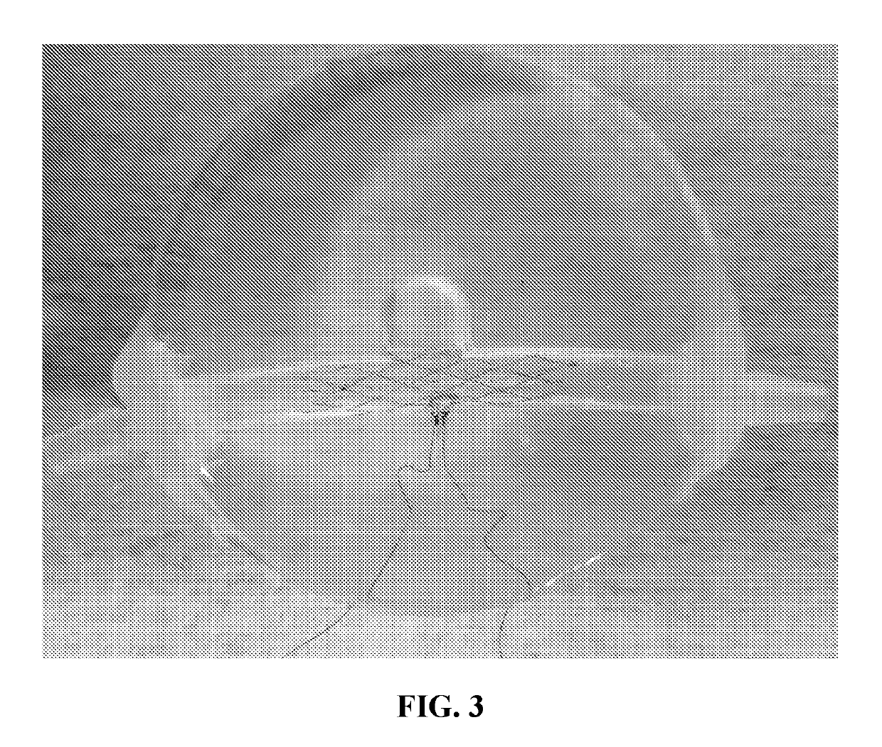 Novel ultra-low profile wireless flow sensors to monitor hemodynamic alterations in the vascular system