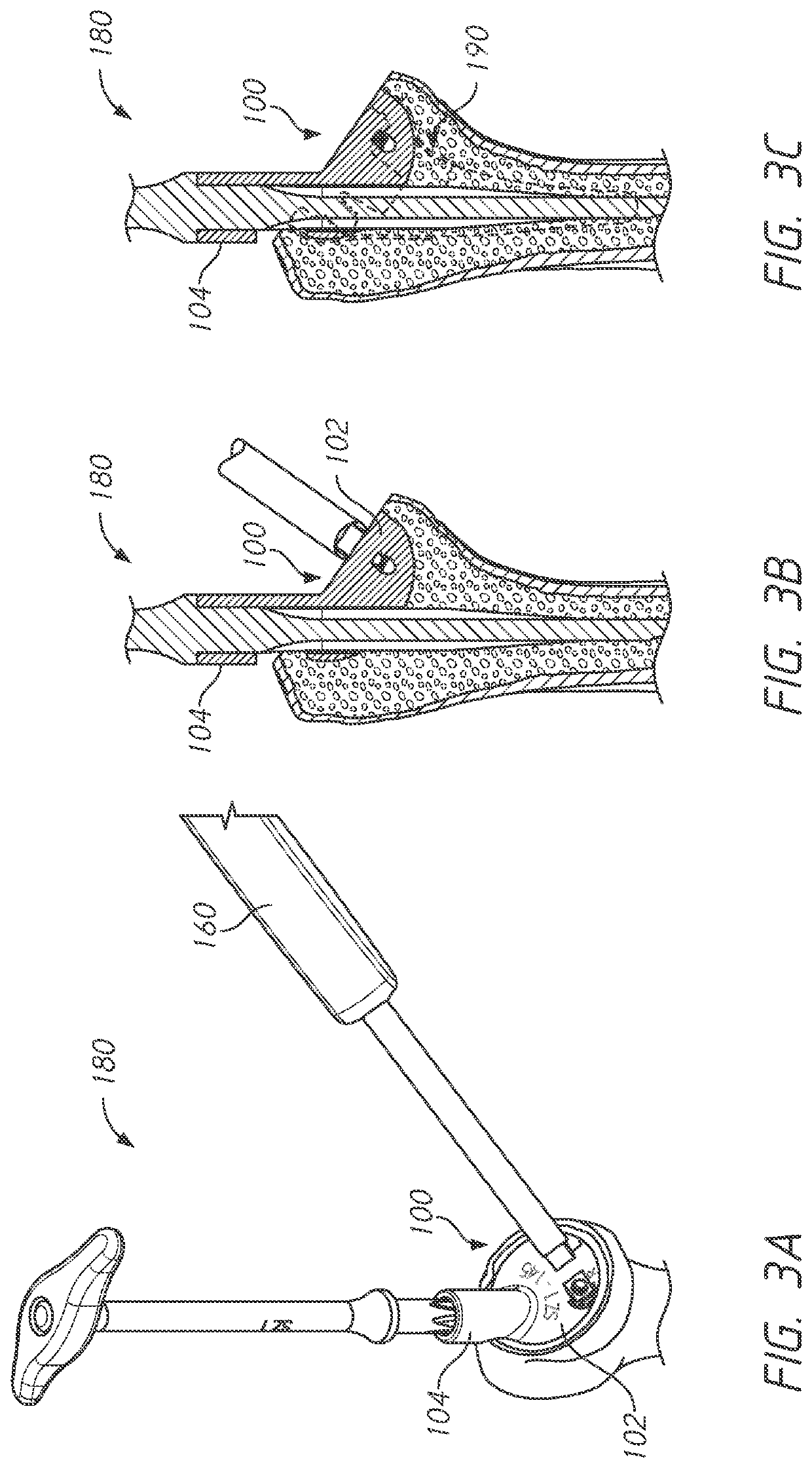 Metaphyseal referencing technique and instrument