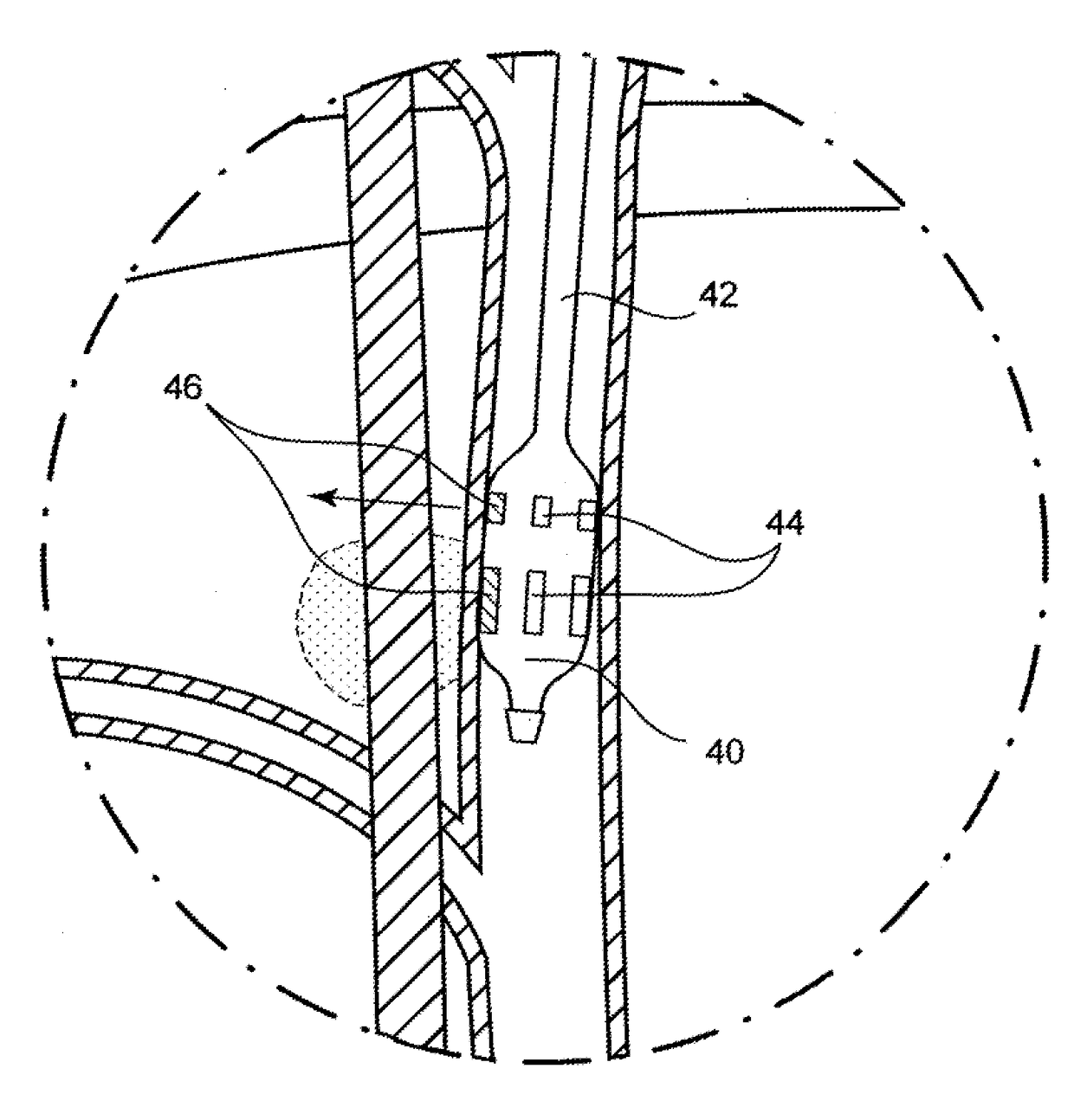 Devices and methods for treatment of heart failure by splanchnic nerve ablation